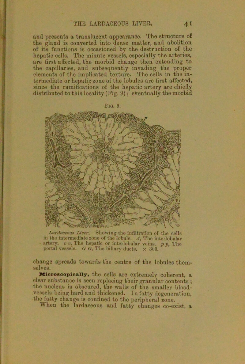 and presents a translucent appearance. The structure of the gland is converted into dense matter, and abolition of its functions is occasioned by the destruction of the hepatic cells. The minute vessels, especially the arteries, are first affected, the morbid change then extending to the capillaries, and subsequently invading the proper elements of the implicated texture. The cells in the in- termediate or hepatic zone of the lobules are first affected, since the ramifications of the hepatic artery are chiefly distributed to this locality (Fig. 9); eventually the morbid Fig. 9. Lnrdaceoui Liver. Showing the infiltration of the cells in the intermediate zone of the lobule. A, The interlobular artery, v v. The hepatic or interlobular veins, p p, The portal vessels. G G, The biliary ducts, x 300. change spreads towards the centre of the lobules them- selves. microscopically, the cells are extremely coherent, a clear substance is seen replacing their granular contents ; the nucleus is obscured, the walls of the smaller blood- vessels being hard and thickened. In fatty degeneration, the fatty change is confined to the peripheral zone. When the lardaceous and fatty changes co-exist, a