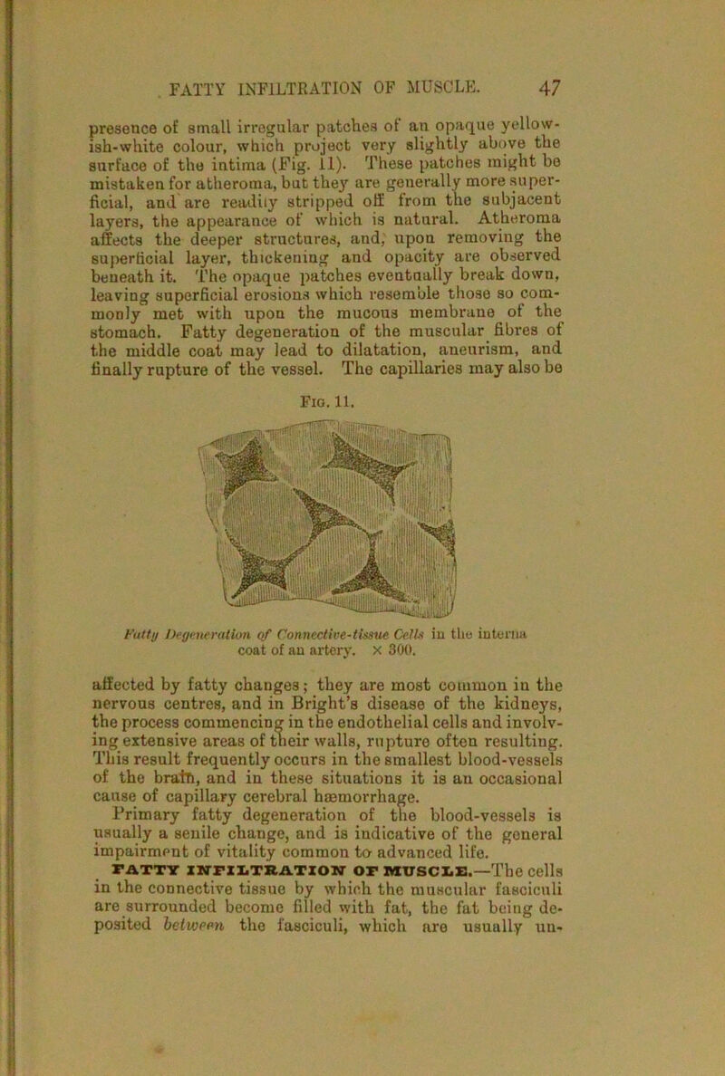 presence of small irregular patches ot an opaque yellow- ish-white colour, which project very slightly above the surface of the intima (Fig. 11). These patches might bo mistaken for atheroma, but they are generally more super- ficial, and are readily stripped oil from the subjacent layers, the appearance of which is natural. Atheroma affects the deeper structures, and, upon removing the superficial layer, thickening and opacity are observed beneath it. The opaque patches eventually break down, leaving superficial erosions which resemble those so com- monly met with upon the mucous membrane of the stomach. Fatty degeneration of the muscular fibres of the middle coat may lead to dilatation, aneurism, and finally rupture of the vessel. The capillaries may also be Fio. 11. Fatty Degeneration of Connective-tissue Cells in tin; interna coat of an artery, x 300. affected by fatty changes; they are most common in the nervous centres, and in Bright’s disease of the kidneys, the process commencing in the endothelial cells and involv- ing extensive areas of their walls, rupture often resulting. This result frequently occurs in the smallest blood-vessels of the brain, and in these situations it is au occasional cause of capillary cerebral haemorrhage. Primary fatty degeneration of the blood-vessel3 is usually a senile change, and is indicative of the general impairment of vitality common to advanced life. PATTY INFILTRATION OP MUSCLE.—The Cells in the connective tissue by which the muscular fasciculi are surrounded become filled with fat, the fat being de- posited between the fasciculi, which are usually un»