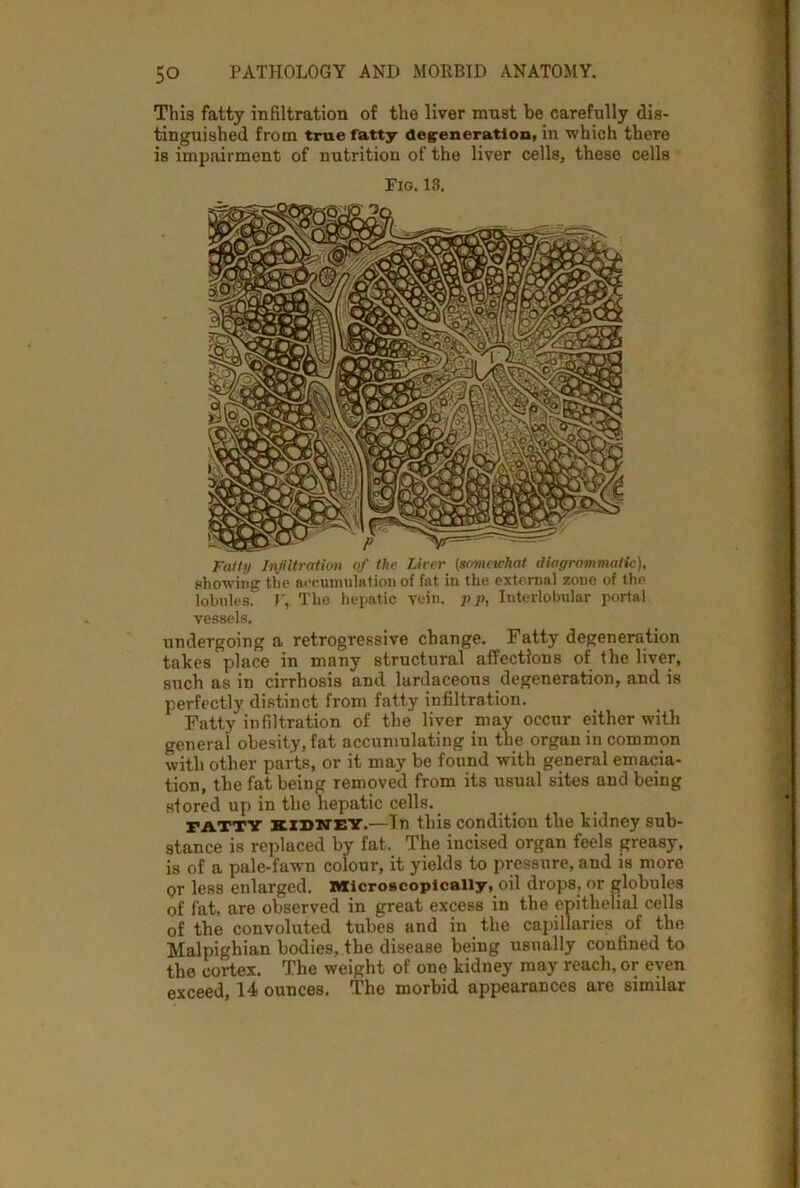 This fatty infiltration of the liver must be carefully dis- tinguished from true fatty degeneration, in which there is impairment of nutrition of the liver cells, these cellB Fig. 13. Fatty Infiltration of the Liver (sovmvhat diagrammatic), showing the accumulation of fat in the external zone of the lobules. P, The hepatic vein. }> p, Interlobular portal vessels. undergoing a retrogressive change. Fatty degeneration takes place in many structural affections of the liver, such as in cirrhosis and lardaceous degeneration, and is perfectly distinct from fatty infiltration. Fatty infiltration of the liver may occur either with general obesity, fat accumulating in the organ in common with other parts, or it may be found with general emacia- tion, the fat being removed from its usual sites and being stored up in the hepatic cells. fatty kidney.—In this condition the kidney sub- stance is replaced by fat. The incised organ feels greasy, is of a pale-fawn colour, it yields to pressure, and is more or less enlarged. Microscopically, oil drops, or globules of fat, are observed in great excess in the epithelial cells of the convoluted tubes and in the capillaries of the Malpighian bodies, the disease being usually confined to the cortex. The weight of one kidney may reach, or even exceed, 14 ounces. The morbid appearances are similar