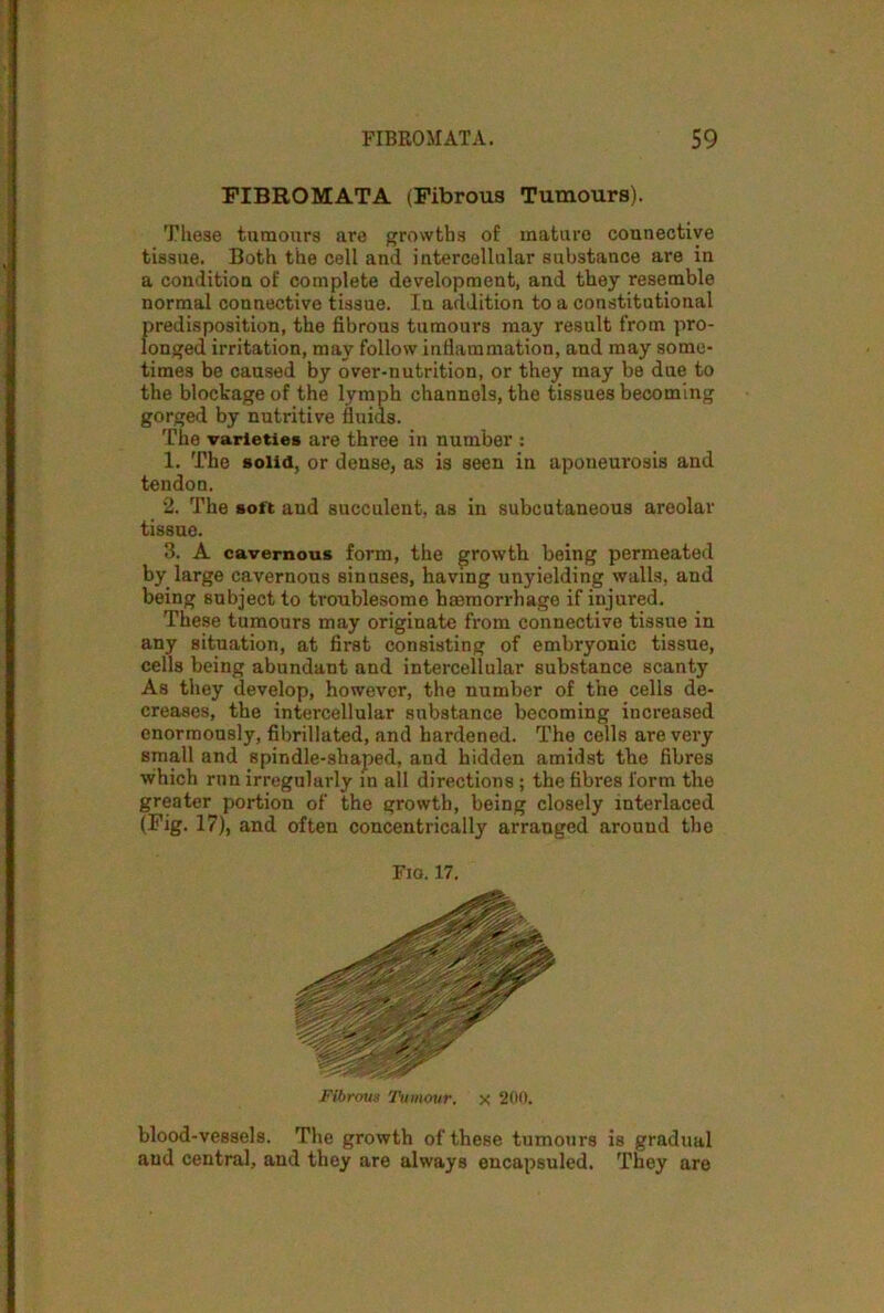 FIBROMATA (Fibrous Tumours). These tumours are growths of mature connective tissue. Both the cell and intercellular substance are in a condition of complete development, and they resemble normal connective tissue. In addition to a constitutional predisposition, the fibrous tumours may result from pro- longed irritation, may follow inflammation, and may some- times be caused by over-nutrition, or they may be due to the blockage of the lymph channels, the tissues becoming gorged by nutritive fluids. The varieties are three in number : 1. The solid, or dense, as is seen in aponeurosis and tendon. 2. The soft and succulent, as in subcutaneous areolar tissue. 3. A cavernous form, the growth being permeated by large cavernous sinuses, having unyielding walls, and being subject to troublesome haemorrhage if injured. These tumours may originate from connective tissue in any situation, at first consisting of embryonic tissue, cells being abundant and intercellular substance scanty As they develop, however, the number of the cells de- creases, the intercellular substance becoming increased enormously, fibrillated, and hardened. The cells are vei'y small and spindle-shaped, and hidden amidst the fibres which run irregularly in all directions ; the fibres form the greater portion of the growth, being closely interlaced (Fig. 17), and often concentrically arranged around the blood-vessels. The growth of these tumours is gradual and central, and they are always encapsuled. They are Fio. 17. Fibrous Tumour, x 200.