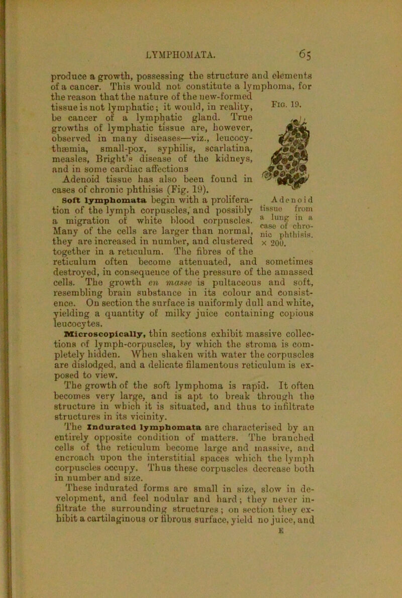 produce a growth, possessing the structure and elements of a cancer. This would not constitute a lymphoma, for the reason that the nature of the new-formed tissueisnot lymphatic; it would, in reality, be cancer of a lymphatic gland. True growths of lymphatic tissue are, however, observed in many diseases—viz., leucocy- thsemia, small-pox, syphilis, scarlatina, measles, Bright’s disease of the kidneys, and in some cardiac affections Adenoid tissue has also been found in cases of chronic phthisis (Fig. 19). Soft lymphomata begin with a prolifera- tion of the lymph corpuscles, and possibly a migration of white blood corpuscles. Many of the cells are larger than normal, they are increased in number, and clustered together in a reticulum. The fibres of the reticulum often become attenuated, and sometimes destroyed, in consequence of the pressure of the amassed cells. The growth en masse is pultaceous and soft, resembling brain substance in its colour and consist- ence. On section the surface is uniformly dull and white, yielding a quantity of milky juice containing copious leucocytes. Microscopically, thin sections exhibit massive collec- tions of lymph-corpuscles, by which the stroma is com- pletely hidden. When shaken with water the corpuscles are dislodged, and a delicate filamentous reticulum is ex- posed to view. The growth of the soft lymphoma is rapid. It often becomes very large, and is apt to break through the structure in which it is situated, and thus to infiltrate structures in its vicinity. The Indurated lympbomata are characterised by an entirely opposite condition of matters. The branched cells of the reticulum become large and massive, and encroach upon the interstitial spaces which the lymph corpuscles occupy. Thus these corpuscles decrease both in number and size. These indurated forms are small in size, slow in de- velopment, and feel nodular and hard; they never in- filtrate the surrounding structures ; on section they ex- hibit a cartilaginous or fibrous surface, yield no juice, and £ Fig. 10. Adenoid tissue from a lung in a ease of chro- nic phthisis, x 200.