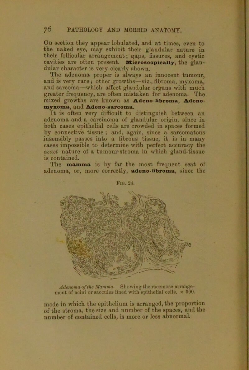 On section they appear tabulated, and at times, even to the naked eye, may exhibit their glandular nature in their follicular arrangement; gaps, fissures, and cystic cavities are often present. Microscopically, the glan- dular character is very clearly shown. The adenoma proper is always an innocent tumour, and is very rare ; other growths—viz., fibroma, myxoma, and sarcoma—which affect glandular organs with much greater frequency, are often mistaken for adenoma. The mixed growths are known as Adeno-fibroma, Adeno- myxoma, and Adeno-sarcoma. It is often very difficult to distinguish between an adenoma and a carcinoma of glandular origin, since in both cases epithelial cells are crowded in spaces formed by connective tissue ; and, again, since a sarcomatous insensibly passes into a fibrous tissue, it is in many cases impossible to determine with perfect accuracy the exact nature of a tumour-stroma in which gland-tissue is contained. The mamma is by far the most frequent seat of adenoma, or, more correctly, adeno-fibroma. since the Fig. 24. Adenoma of the Mamma. Showing the racemose arrange- ment of acini or saccules lined with epithelial cells, x 300. mode in which the epithelium is arranged, the proportion of the stroma, the size and number of the spaces, and the number of contained cells, is more or less abnormal.
