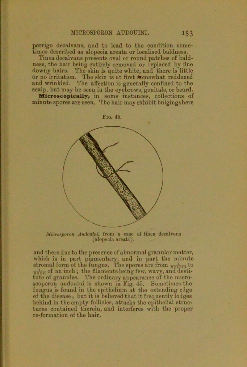 porrigo decalvaDs, and to lead to the condition some- times described as alopecia areata or localised baldness. Tinea decalvans presents oval or round patches of bald- ness, the hair being entirely removed or replaced by fine downy hairs. The skin is quite white, and there is little or no irritation. The skin is at first Somewhat reddened and wrinkled. The affection is generally confined to the scalp, but may be seen in the eyebrows, genitals, or beard. Microscopically, in some instances, collections of minute spores are seen. The hair may exhibit bulgingshere Microsporon Audouini, from a case of tinea decalvans (alopecia areata). and there due to the presence of abnormal granular matter, which is in part pigmentary, and in part the minute stromal form of the fungus. The spores are from 26000 f° ?oVo an hi eh ; the filaments being few, wavy, and desti- tute of granules. The ordinary appearance of the micro- scoporon audouini is shown in Fig. 45. Sometimes the fungus is found in the epithelium at the extending edge of the disease; but it is believed that it frequently lodges behind in the empty follicles, attacks the epithelial struc- tures contained therein, and interferes with the proper re-formation of the hair. Fig. 45.