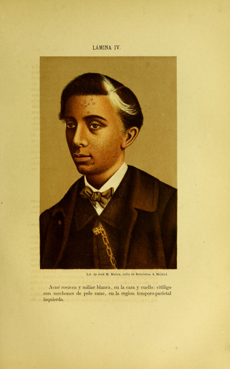 Acné rosácea y miliar blanca, en la cara y cuello: vitÍligo con mechones de pelo cano, en la región temporo-parietal izquierda. I,it. (le José M. Mateu, calle de Recoletos, 4, Madrid.