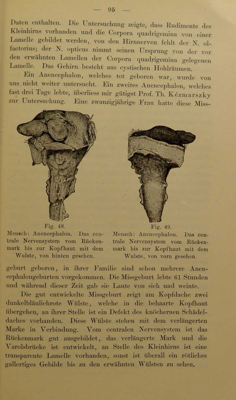 Paten enthalten. Pie Untersuchung zeigte, dass Rudimente des Kleinhirns vorhanden und die Corpora quadrigemina von einer Lamelle gebildet werden, von den Hirnnerven fehlt der X. ol- factorius; der X. opticus nimmt seinen Ursprung von der vor den ei wähnten Lamellen der Corpora quadrigemina gelegenen Lamelle. Pas Gehirn besteht aus cystischen Hohlräumen. Ein Anencephalon, welches tot geboren war, wurde von uns nicht weiter untersucht. Ein zweites Anencephalon, welches fast di ei Tage lebte, überliess mir giftigst Prof. Th. Kezmarszky zur Untersuchung. Eine zwanzigjährige Frau hatte diese Miss- Fig. 48. Mensch: Anencephalon. Das cen- trale Nervensystem vom Rücken- mark bis zur Kopfhaut mit dem Wulste, von hinten gesehen. Fig. 49. Mensch: Anencephalon. Das cen- trale Nervensystem vom Rücken- mark bis zur Kopfhaut mit dem Wulste, von vorn gesehen. gebürt geboren, in ihrer Familie sind schon mehrere Anen- cephalongeburten vorgekommen. Pie Missgeburt lebte 61 Stunden und während dieser Zeit gab sie Laute von sich und weinte. Pie gut entwickelte Missgeburt zeigt am Kopfdache zwei dunkel bläulichrote Wülste, welche in die behaarte Kopfhaut übergehen, an ihrer Stelle ist ein Pefekt des knöchernen Schädel- daches vorhanden. Piese Wulste stehen mit dem verlängerten Marke in Verbindung. Vom centralen Nervensystem ist das Rückenmark gut ausgebildet, das verlängerte Mark und die Varolsbrücke ist entwickelt, an Stelle des Kleinhirns ist eine transparente Lamelle vorhanden, sonst ist überall ein rötliches gallertiges Gebilde bis zu den erwähnten Wülsten zu sehen.
