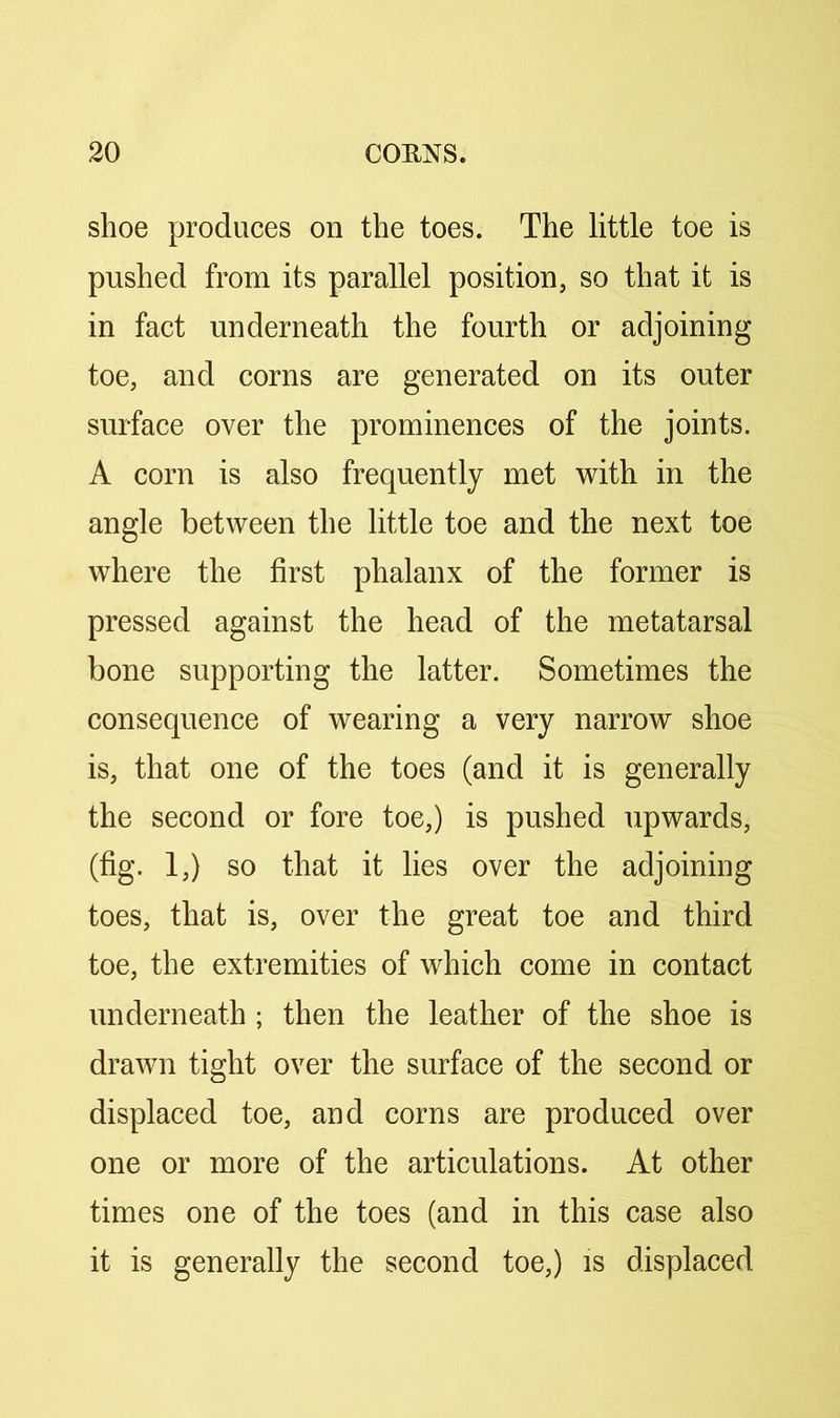 shoe produces on the toes. The little toe is pushed from its parallel position, so that it is in fact underneath the fourth or adjoining toe, and corns are generated on its outer surface over the prominences of the joints. A corn is also frequently met with in the angle between the little toe and the next toe where the first phalanx of the former is pressed against the head of the metatarsal bone supporting the latter. Sometimes the consequence of wearing a very narrow shoe is, that one of the toes (and it is generally the second or fore toe,) is pushed upwards, (fig. 1,) so that it lies over the adjoining toes, that is, over the great toe and third toe, the extremities of which come in contact underneath ; then the leather of the shoe is drawn tight over the surface of the second or displaced toe, and corns are produced over one or more of the articulations. At other times one of the toes (and in this case also it is generally the second toe,) is displaced