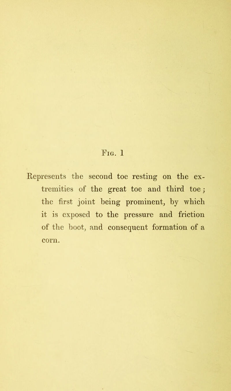 Represents the second toe resting on the ex- tremities of the great toe and third toe; the first joint being prominent^ by which it is exposed to the pressure and friction of the boot, and consequent formation of a corn.