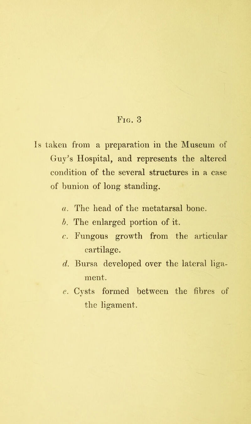 Is taken from a preparation in the Museum of Guy^s Hospital, and represents the altered condition of the several structures in a case of bunion of long standing. a. The head of the metatarsal bone. b. The enlarged portion of it. c. Fungous growth from the articular cartilage. d. Bursa developed over the lateral liga- ment. e. Cvsts formed between the fibres of the ligament.