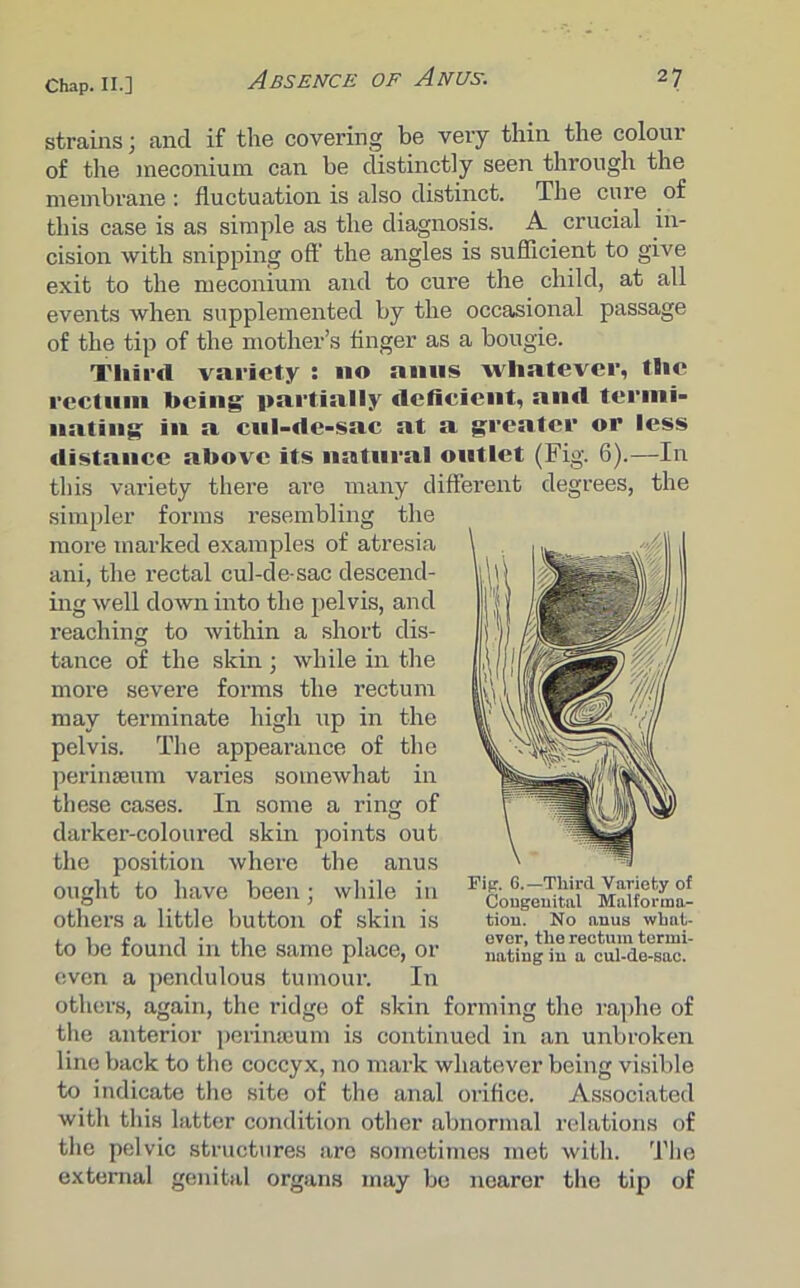 strains; and if the covering be very thin the colour of the meconium can be distinctly seen through the membrane : fluctuation is also distinct. The cure of this case is as simple as the diagnosis. A crucial in- cision with snipping off the angles is sufficient to give exit to the meconium and to cure the child, at all events when supplemented by the occasional passage of the tip of the mother’s finger as a bougie. Third variety : no anus whatever, the rectum being partially deficient, and termi- nating in a cul-de-sac at a greater or less distance above its natural outlet (Fig. 6).—In this variety there are many different degrees, the simpler forms resembling the more marked examples of atresia ani, the rectal cul-de-sac descend- ing well down into the pelvis, and reaching to within a short dis- tance of the skin ; while in the more severe forms the rectum may terminate high up in the pelvis. The appearance of the perinseum varies somewhat in these cases. In some a ring of darker-coloured skin points out the position where the anus ought to have been; while in others a little button of skin is to be found in the same place, or oven a pendulous tumour. In others, again, the ridge of skin forming the raphe of the anterior perinseum is continued in an unbroken line back to the coccyx, no mark whatever being visible to indicate the site of the anal orifice. Associated with this latter condition other abnormal relations of the pelvic structures are sometimes met with. The external genital organs may be nearer the tip of Fig. 6.—Third Variety of Congenital Malforma- tion. No anus what- ever, the rectum termi- nating in a cul-de-sac.