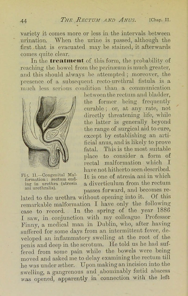 variety it comes more or less in the intervals between urination. When the urine is passed, although the first that is evacuated may be stained, it afterwards comes quite clear. In the treatment of this form, the probability of reaching the bowel from the perimeum is much greater, and this should always be attempted; moreover, the presence of a subsequent recto-urethral fistula is a much less serious condition than a communication in? in urethra (atresia a diverticulum from the rectum ani urothraiis). passes forward, and becomes re- lated to the urethra without opening into it. Of this remarkable malformation I have only the following case to record. In the spring of the year 1886 I saw, in conjunction with my colleague Professor Finny, a medical man in Dublin, who, after having suffered for some days from an intermittent fever, de- veloped an inflammatory swelling at the root of the penis and deep in the scrotum, lie told us he had suf- fered from some pain while the bowels were being moved and asked me to delay examining the rectum till he was under aether. Upon making an incision into the swelling, a gangrenous and abominably foetid abscess was opened, apparently in connection with the left Fi'. 11.—Congenital Mnl- formation : rectum end- between the rectum and bladder, the former being frequently curable; or, at any rate, not directly threatening life, while the latter is generally beyond the range of surgical aid to cure, except by establishing an arti- ficial anus, and is likely to prove fatal. This is the most suitable place to consider a form of rectal malformation which I have not hitherto seen described. It is one of atresia ani in which