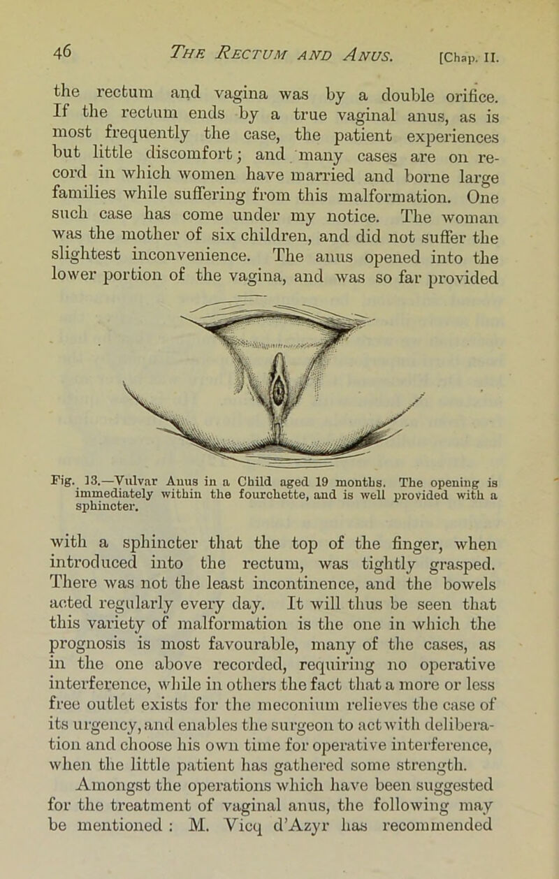 [Chap. II. the rectum and vagina was by a double orifice. If the rectum ends by a true vaginal anus, as is most frequently the case, the patient experiences but little discomfort; and many cases are on re- cord in which women have married and borne large families while suffering from this malformation. One such case has come under my notice. The woman was the mother of six children, and did not suffer the slightest inconvenience. The anus opened into the lower portion of the vagina, and was so far provided Fig. 13.—Vulvar Anus in a Child aged 19 months. The opening is immediately within the fourchette, and is well provided with a sphincter. with a sphincter that the top of the finger, when introduced into the rectum, was tightly grasped. There was not the least incontinence, and the bowels acted regularly every day. It will thus be seen that this variety of malformation is the one in which the prognosis is most favourable, many of the cases, as in the one above recorded, requiring no operative interference, while in others the fact that a more or less free outlet exists for the meconium relieves the case of its urgency, and enables the surgeon to act with delibera- tion and choose his own time for operative interference, when the little patient has gathered some strength. Amongst the operations which have been suggested for the treatment of vaginal anus, the following may be mentioned : M. Vicq dAzyr has recommended