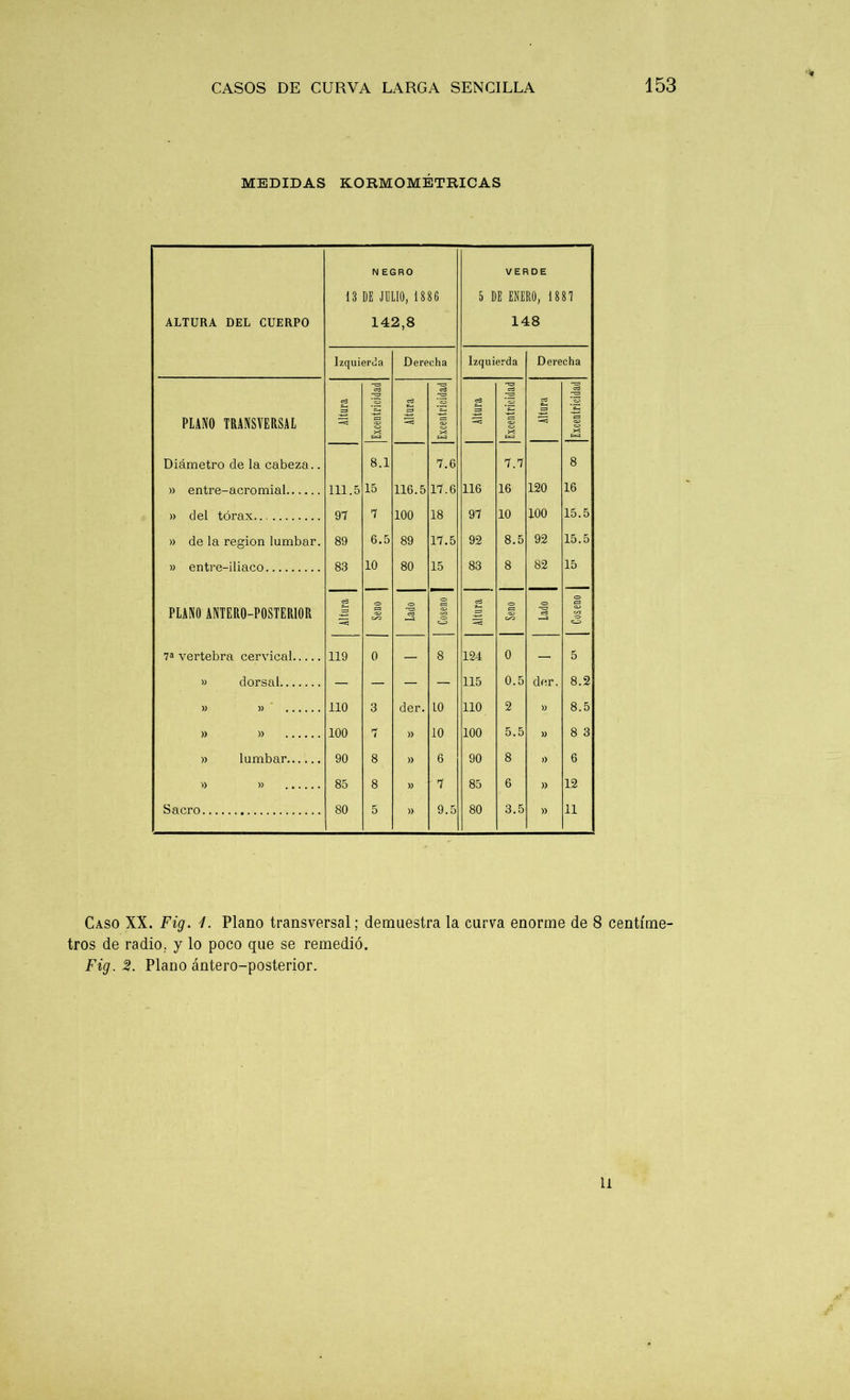MEDIDAS KORMOMÉTRICAS NEGRO VERDE 13 DE JULIO, 1886 5 DE ENERO, 1881 ALTURA DEL CUERPO 142,8 148 Izquierda Derecha Izquierda Derecha c3 cá cd cd cd cd *3 g 33 cd *03 PLANO TRANSVERSAL s=3 03 X w 03 w ¡= 03 X e= 03 X Diámetro de la cabeza.. 8.1 7.6 7.7 8 » entre-acromial 111 5 15 116.5 17.6 116 16 120 16 » del tórax 97 7 100 18 97 10 100 15.5 » de la región lumbar. 89 6.5 89 17.5 92 8.5 92 15.5 » entre-iliaco 83 10 80 15 83 8 82 15 PLANO ANTERO-POSTERIOR Altura o> S=J «33 cd •—-a Coseno Altura «o 03 C3 cd » '7 Coseno 7a vertebra cervical 119 0 — 8 124 0 — 5 » dorsal — — — — 115 0.5 der. 8.2 )) )) 110 3 der. 10 110 2 8.5 )) )) 100 7 )) 10 100 5.5 » 8 3 » lumbar 90 8 )) 6 90 8 )) 6 » )) 85 8 )) 7 85 6 )> 12 Sacro 80 5 » 9.5 80 3.5 » 11 Caso XX. Fig. 1. Plano transversal; demuestra la curva enorme de 8 centíme- tros de radio, j lo poco que se remedió. Fig. 2. Plano ántero-posterior. U
