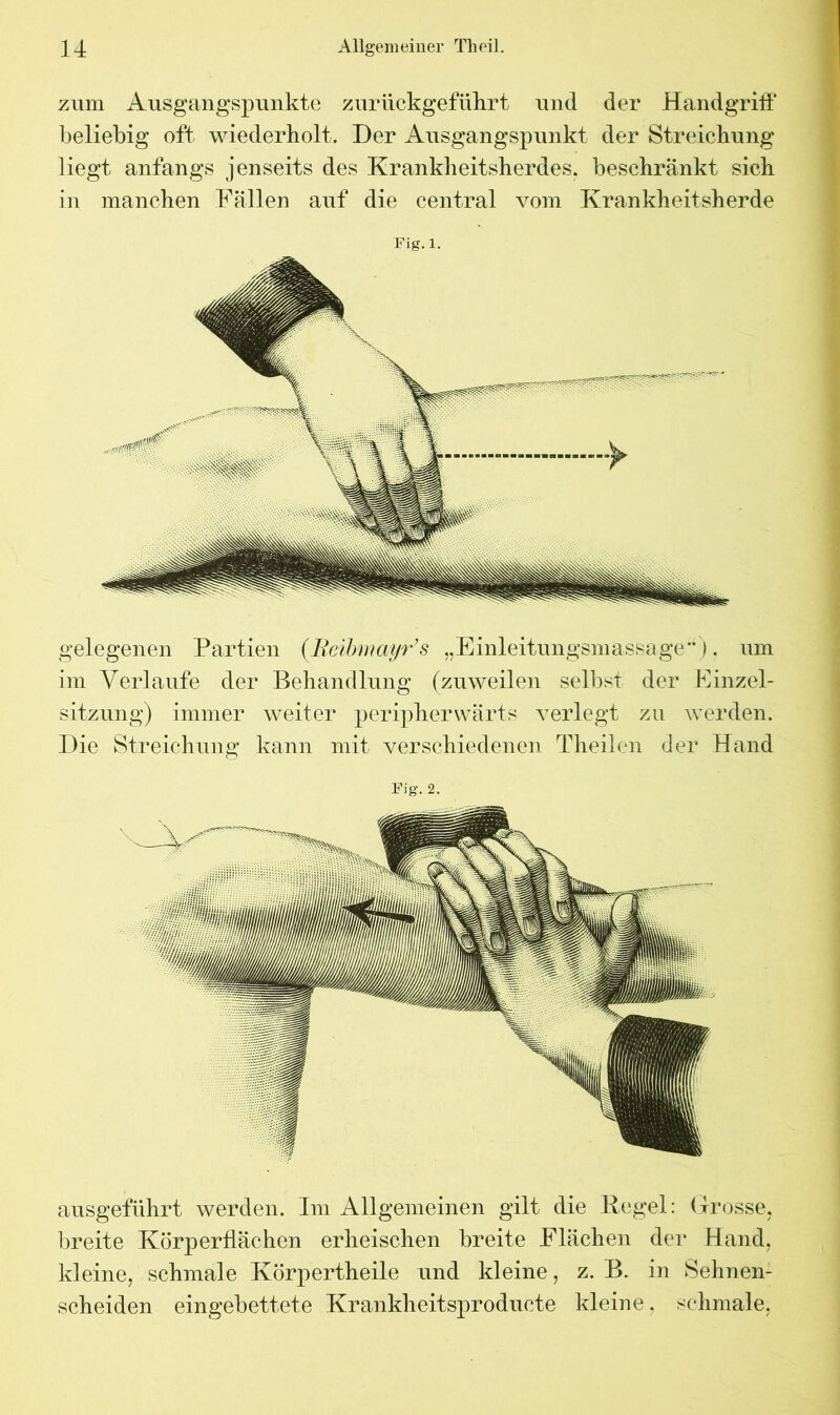 zum Ausgangspunkte zurückgeführt und der Handgriff beliebig oft wiederholt. Her Ausgangspunkt der Streichung liegt anfangs jenseits des Krankheitsherdes, beschränkt sich in manchen Fällen auf die central vom Krankheitsherde Fig.l. gelegenen Partien (Reibmayr’s „Einleitungsmassage*‘). um im Verlaufe der Behandlung (zuweilen selbst der Finzel- sitzung) immer weiter peripher wärt s verlegt zu werden. Die Streichung kann mit verschiedenen Theilen der Hand Fig.2. ausgeführt werden. Im Allgemeinen gilt die Kegel: Grosse, breite Körperflächen erheischen breite Flächen der Hand, kleine, schmale Körpertheile und kleine, z. B. in Sehnen- scheiden eingebettete Krankheitsproducte kleine, schmale.