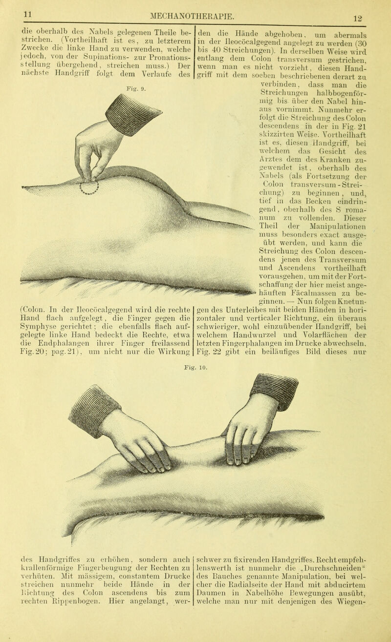 12 die oberhalb des Nabels gelegenen Theile be- strichen. (Vortheilhaft ist es, zu letzterem Zwecke die linke Hand zn verwenden, welche jedoch, von der Supinations- zur Pronations- stellung übergehend, streichen muss.) Der nächste Handgriff folgt dem Verlaufe des (Colon. In der Jleocöcalgegend wird die rechte Hand flach aufgelegt, die Finger gegen die Symphyse gerichtet; die ebenfalls flach auf- gelegte linke Hand bedeckt die Rechte, etwa die Endphalangen ihrer Finger freilassend Fig. 20; pag. 21), um nicht nur die Wirkung den die Hände abgehoben, um abermals in der Ileocöcalgegend angelegt zu werden (30 bis 40 Streichungen). In derselben Weise wird entlang dem Colon transversum gestrichen, wenn man es nicht vorzieht, diesen Hand- griff mit dem soeben beschriebenen derart zu verbinden, dass man die Streichungen halbbogenför- mig bis über den Nabel hin- aus vornimmt. Nunmehr er- folgt die Streichung des Colon descendens in der in Fig. 21 skizzirten Weise. Vortheilhaft ist es, diesen Handgriff, bei welchem das Gesicht des Arztes dem des Kranken zu- gewendet ist, oberhalb des Nabels (als Fortsetzung der Colon transversum - Strei- chung) zu beginnen , und> tief in das Becken eindrin- gend , oberhalb des S roma- zu vollenden. Dieser der Manipulationen muss besonders exact ausge- übt werden, und kann die Streichung des Colon descen- dens jenen des Transversum und Ascendens vortheilhaft vorausgehen, um mit der Fort- schaffung der hier meist ange- häuften Fäcalmassen zu be- ginnen. — Nun folgen Knetun- gen des Unterleibes mit beiden Händen in hori- zontaler und verticaler Richtung, ein überaus schwieriger, wohl einzuübender Handgriff, bei welchem Handwurzel und Volarflächen der letzten Fingerphalangen im Drucke abwechseln. Fig. 22 gibt ein beiläufiges Bild dieses nur Fig. 10. des Handgriffes zu erhöhen, sondern auch krallenförmige Fingerbeugung der Rechten zu verhüten. Mit mässigem, constantem Drucke streichen nunmehr beide Hände in der Richtung des Colon ascendens bis zum rechten Rippenbogen. Hier angelangt, wer- schwer zu fixirenden Handgriffes. Recht empfeli- lenswerth ist nunmehr die „Durchschneiden“ des Bauches genannte Manipulation, bei wel- cher die Radialseite der Hand mit abducirtem Daumen in Nabelhöhe Bewegungen ausübt, welche man nur mit denjenigen des Wiegen-