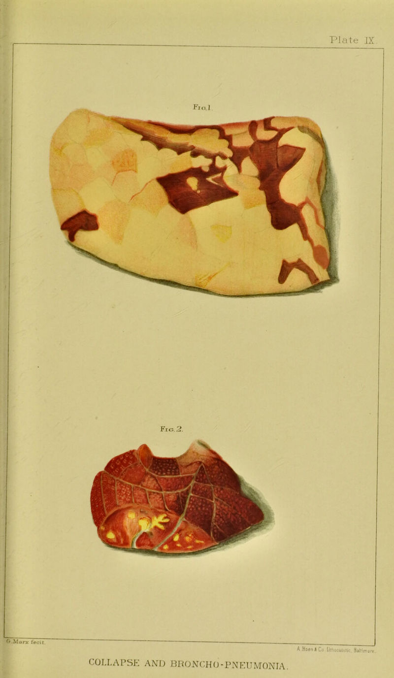 Fial Fig. 2. Ct Marx fecit. — A Hoen 1 Co.lirhocaDt.1ic. Saltimgre. COLLAPSK AND BPONCHfJ-PNPXIMONIA.