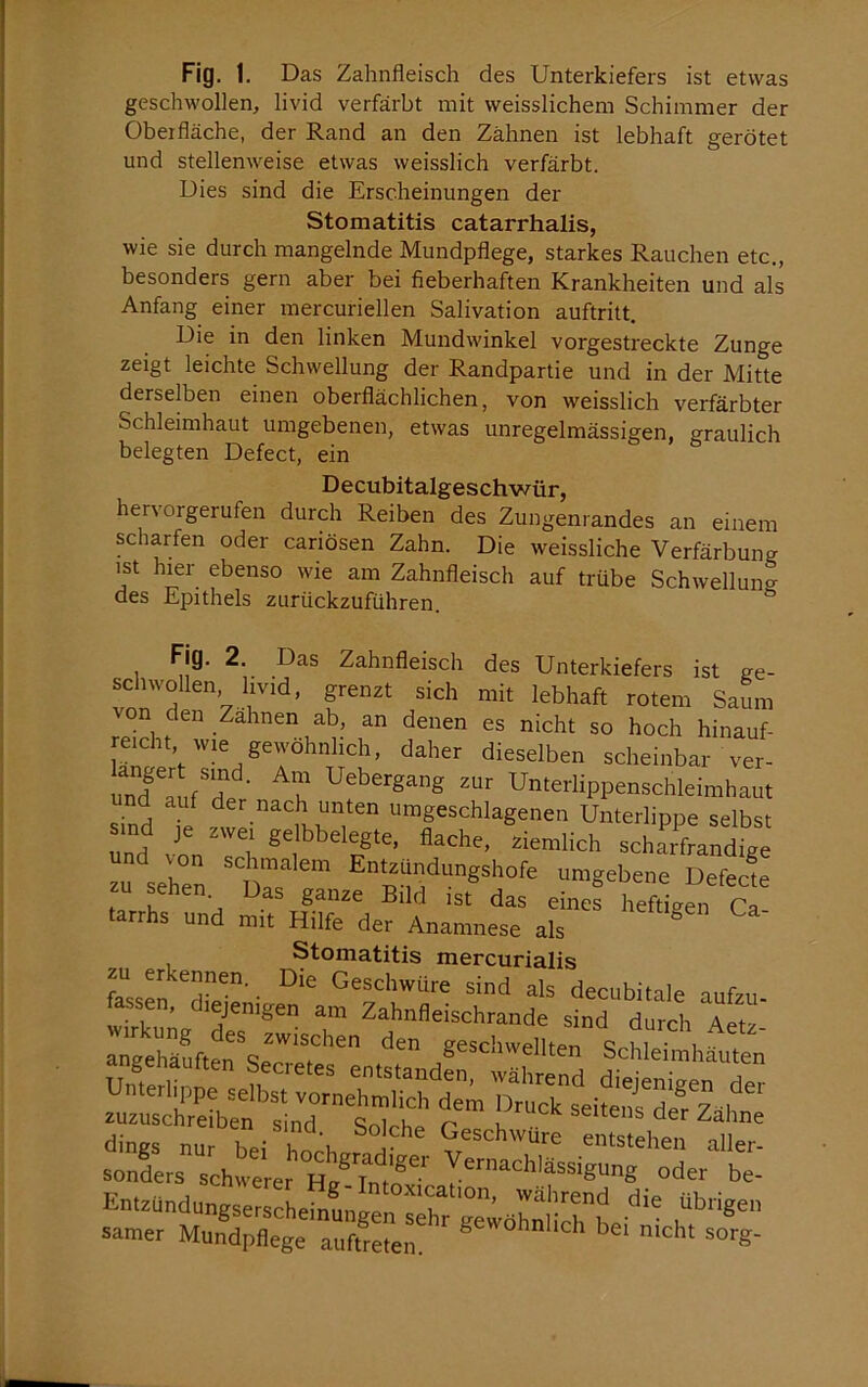 Fig. 1. Das Zahnfleisch des Unterkiefers ist etwas geschwollen, livid verfärbt mit weisslichem Schimmer der Obeifläche, der Rand an den Zähnen ist lebhaft gerötet und stellenweise etwas weisslich verfärbt. Dies sind die Erscheinungen der Stomatitis catarrhalis, wie sie durch mangelnde Mundpflege, starkes Rauchen etc., besonders gern aber bei fieberhaften Krankheiten und als Anfang einer mercuriellen Salivation auftritt. Die in den linken Mundwinkel vorgestreckte Zunge zeigt leichte Schwellung der Randpartie und in der Mitte derselben einen oberflächlichen, von weisslich verfärbter Schleimhaut umgebenen, etwas unregelmässigen, graulich belegten Defect, ein Decubitalgeschwür, hervorgerufen durch Reiben des Zungenrandes an einem scharfen oder cariösen Zahn. Die weissliche Verfärbung ist hier ebenso wie am Zahnfleisch auf trübe Schwellung des Epithels zurückzuführen. ^ Fig. 2, Das Zahnfleisch des Unterkiefers ist ae- schwollen livid, grenzt sich mit lebhaft rotem Saum von den Zahnen ab, an denen es nicht so hoch hinauf- retcht tvie gewöhnlich, daher dieselben scheinbar ver- unTIuf'de ■ n Uebergang zur Unterlippenschleimhaut nd auf der nach unten umgeschlagenen Unterlippe selbst sind ,e zwei gelbbelegte, flache, ziemlich schMfrandige L seien '0^ ” ^“'»“«»''ofe umgebene Defecle , , ■ . gäiize Bild ist das eines heftigen Ca tarrhs und mit Hilfe der Anamnese als ® Stomatitis mercurialis zu erkennen. Die Geschwüre sind als decubitale aufzu Ittag des'®' 7 Zalmfleischrande sind durch Aetli ^ des zwischen den ffeschwf^llf'^^rt i zuzuschreiben sind r u ■ der Zahne stSraTch^«r