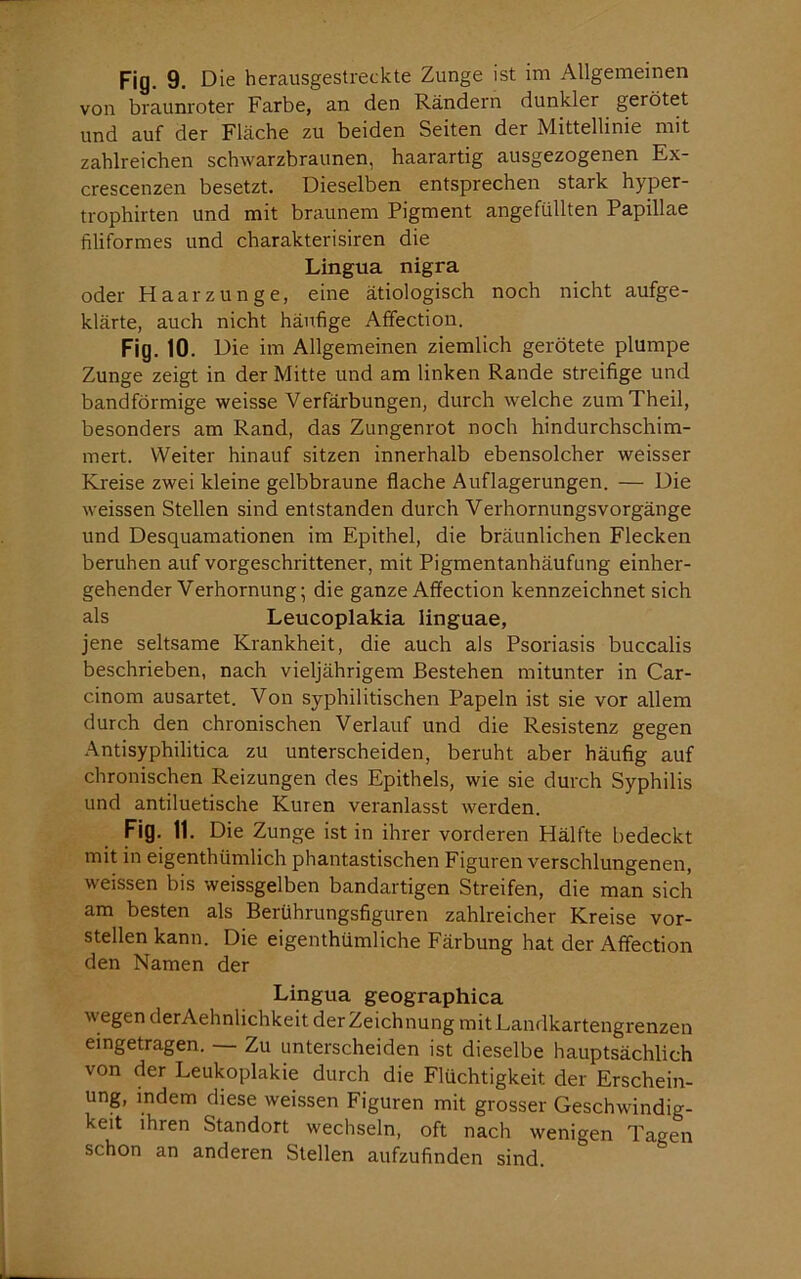 von braunroter Farbe, an den Rändern dunkler gerötet und auf der Fläche zu beiden Seiten der Mittellinie mit zahlreichen schwarzbraunen, haarartig ausgezogenen Ex- crescenzen besetzt. Dieselben entsprechen stark hyper- trophirten und mit braunem Pigment angefüllten Papillae filiformes und charakterisiren die Lingua nigra oder Haarzunge, eine ätiologisch noch nicht aufge- klärte, auch nicht häufige Affection. Fig. 10. Die im Allgemeinen ziemlich gerötete plumpe Zunge zeigt in der Mitte und am linken Rande streifige und bandförmige weisse Verfärbungen, durch welche zumTheil, besonders am Rand, das Zungenrot noch hindurchschim- mert. Weiter hinauf sitzen innerhalb ebensolcher weisser Kreise zwei kleine gelbbraune flache Auflagerungen. — Die weissen Stellen sind entstanden durch Verhornungsvorgänge und Desquamationen im Epithel, die bräunlichen Flecken beruhen auf vorgeschrittener, mit Pigmentanhäufung einher- gehender Verhornung; die ganze Affection kennzeichnet sich als Leucoplakia linguae, jene seltsame Krankheit, die auch als Psoriasis buccalis beschrieben, nach vieljährigem Bestehen mitunter in Car- cinom ausartet. Von syphilitischen Papeln ist sie vor allem durch den chronischen Verlauf und die Resistenz gegen Antisyphilitica zu unterscheiden, beruht aber häufig auf chronischen Reizungen des Epithels, wie sie durch Syphilis und antiluetische Kuren veranlasst werden. Fig. 11. Die Zunge ist in ihrer vorderen Hälfte bedeckt mit in eigenthümlich phantastischen Figuren verschlungenen, weissen bis weissgelben bandartigen Streifen, die man sich am besten als Berührungsfiguren zahlreicher Kreise vor- stellen kann. Die eigenthümliche Färbung hat der Affection den Namen der Lingua geographica wegen derAehnlichkeit der Zeichnung mit Landkartengrenzen eingetragen. — Zu unterscheiden ist dieselbe hauptsächlich von der Leukoplakie durch die Flüchtigkeit der Erschein- ung, indem diese weissen Figuren mit grosser Geschwindig- keit ihren Standort wechseln, oft nach wenigen Tagen schon an anderen Stellen aufzufinden sind.