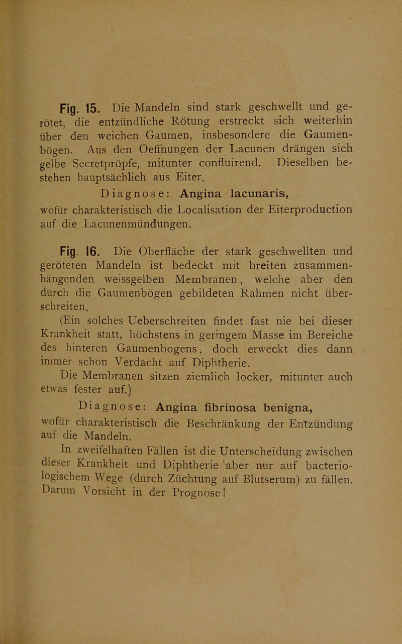 rötet, die entzündliche Rötung erstreckt sich weiterhin über den weichen Gaumen, insbesondere die Gaumen- bögen. Aus den Oeffnungen der Lacunen drängen sich gelbe Secretpröpfe, mitunter confluirend. Dieselben be- stehen hauptsächlich aus Eiter. Diagnose: Angina lacunaris, wofür charakteristisch die Localisation der Eiterproduction auf die Lacunenmündungen. Fig. 16. Die Oberfläche der stark geschwellten und geröteten Mandeln ist bedeckt mit breiten zusammen- hängenden weissgelben Membranen, welche aber den durch die Gaumenbögen gebildeten Rahmen nicht über- schreiten. (Ein solches Ueberschreiten findet fast nie bei dieser Krankheit statt, höchstens in geringem Masse im Bereiche des hinteren Gaumenbogens, doch erweckt dies dann immer schon Verdacht auf Diphtherie. Die Membranen sitzen ziemlich locker, mitunter auch etwas fester auf) Diagnose: Angina fibrinosa benigna, wofür charakteristisch die Beschränkung der Entzündung auf die Mandeln. In zweifelhaften Fällen ist die Unterscheidung zwischen dieser Krankheit und Diphtherie aber nur auf bacterio- logischem Wege (durch Züchtung auf Blutserum) zu fällen. Darum Vorsicht in der Prognose!