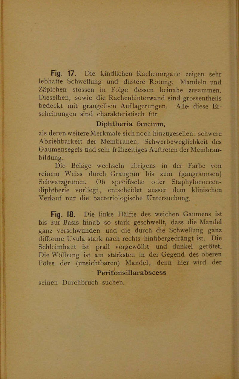 lebhafte Schwellung und düstere Rötung. Mandeln und Zäpfchen stossen in Folge dessen beinahe zusammen. Dieselben, sowie die Rachenhinterwand sind grossentheils bedeckt mit graugelben Auflagerungen. Alle- diese Er- scheinungen sind charakteristisch für Diphtheria faucium, als deren weitere Merkmale sich noch hinzugesellen: schwere Abziehbarkeit der Membranen, Schwerbeweglichkeit des Gaumensegels und sehr frühzeitiges Auftreten der Membran- bildung. Die Beläge wechseln übrigens in der Farbe von reinem Weiss durch Graugrün bis zum (gangränösen) Schwarzgrünen. Ob specifische oder Staphylococcen- diphtherie vorliegt, entscheidet ausser dem klinischen Verlauf nur die bacteriologische Untersuchung. Fig. 18. Die linke Hälfte des weichen Gaumens ist bis zur Basis hinab so stark geschwellt, dass die Mandel ganz verschwunden und die durch die Schwellung ganz dififorme Uvula stark nach rechts hinübergedrängt ist. Die Schleimhaut ist prall vorgewölbt und dunkel gerötet. Die Wölbung ist am stärksten in der Gegend des oberen Boies der (unsichtbaren) Mandel, denn hier wird der Peritonsillarabscess seinen Durchbruch suchen.