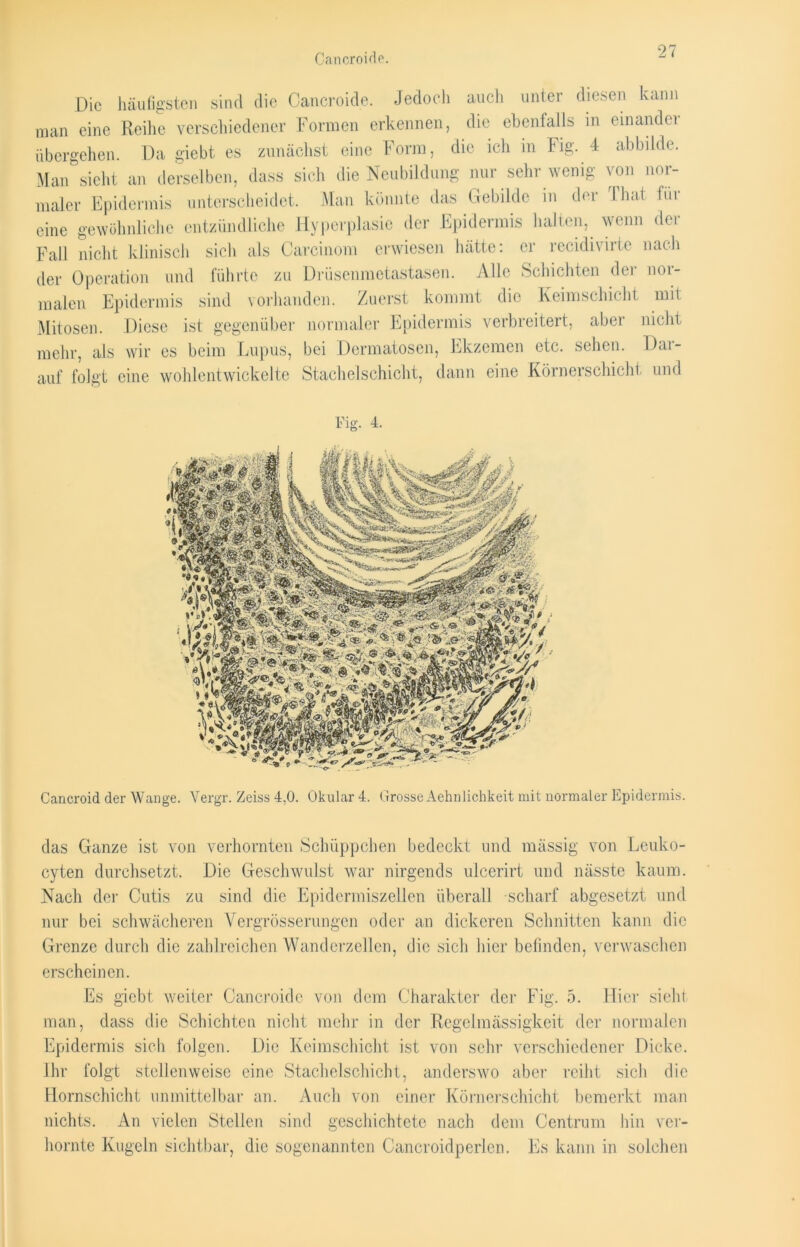 Cancroide. Die häufigsten sind die Cancroide. Jedoch auch unter diesen kann man eine Reihe verschiedener Formen erkennen, die ebenfalls in einandei übergehen. Da giebt es zunächst eine Form, die ich in big. 4 abbilde. Man sieht an derselben, dass sich die Neubildung nur sehr wenig von nor- maler Epidermis unterscheidet. Man könnte das Gebilde in der Thai für eine gewöhnliche entzündliche Hyperplasie der Epidermis halten, wenn der Fall nicht klinisch sich als Carcinom erwiesen hätte: er recidivirte nach der Operation und führte zu Drüsenmetastasen. Alle Schichten der nor- malen Epidermis sind vorhanden. Zuerst kommt die Keimschicht mit Mitosen. Diese ist gegenüber normaler Epidermis verbreitert, aber nicht mehr, als wir es beim Lupus, bei Dermatosen, Ekzemen etc. sehen. Dat- auf folgt eine wohlentwickelte Stachelschicht, dann eine Körnerschicht und Fig. 4. Cancroid der Wange. Vergr. Zeiss 4,0. Okular 4. Grosse Aehnlichkeit mit normaler Epidermis. das Ganze ist von verhornten Schüppchen bedeckt und massig von Leuko- cyten durchsetzt. Die Geschwulst war nirgends ulcerirt und nässte kaum. Nach der Cutis zu sind die Epidermiszellen überall scharf abgesetzt und nur bei schwächeren Vergrösserungen oder an dickeren Schnitten kann die Grenze durch die zahlreichen Wanderzellen, die sich hier befinden, verwaschen erscheinen. Es giebt weiter Cancroide von dem Charakter der Fig. 5. Hier sieht man, dass die Schichten nicht mehr in der Regelmässigkeit der normalen Epidermis sich folgen. Die Keimschicht ist von sehr verschiedener Dicke. Ihr folgt stellenweise eine Stachelschicht, anderswo aber reiht sich die Hornschicht unmittelbar an. Auch von einer Körnerschicht bemerkt man nichts. An vielen Stellen sind geschichtete nach dem Centrum hin ver- hornte Kugeln sichtbar, die sogenannten Cancroidperlen. Es kann in solchen