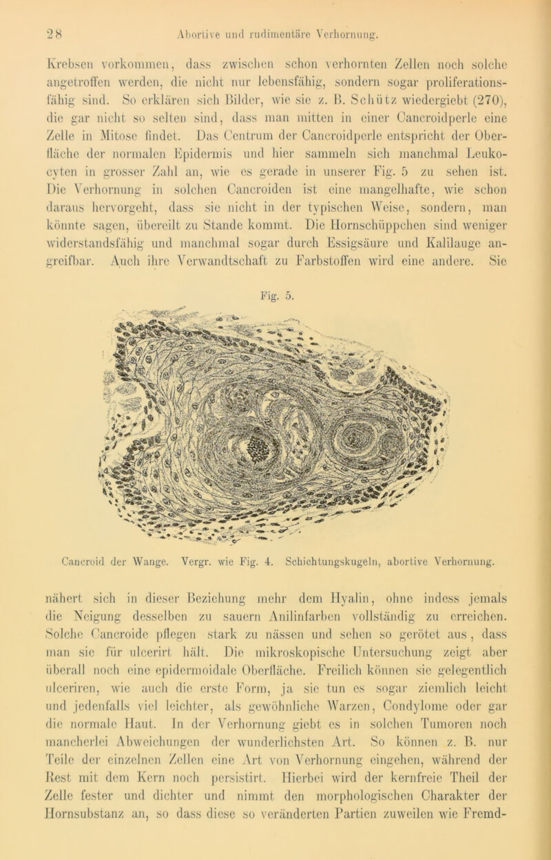 Krebsen verkommen, dass zwischen schon verhornten Zellen noch solche angetroffen werden, die nicht nur lebensfähig, sondern sogar proliferations- fähig sind. So erklären sich Bilder, wie sie z. B. Schütz wiedergiebt (270), die gar nicht so selten sind, dass man mitten in einer Cancroidperle eine Zelle in Mitose findet. Das Centrum der Cancroidperle entspricht der Ober- fläche der normalen Epidermis und hier sammeln sich manchmal Leuko- cyten in grosser Zahl an, wie es gerade in unserer Fig. 5 za sehen ist. Die Verhornung in solchen Cancroiden ist eine mangelhafte, wie schon daraus hervorgeht, dass sie nicht in der typischen Weise, sondern, man könnte sagen, übereilt zu Stande kommt. Die Hornschüppchen sind weniger widerstandsfähig und manchmal sogar durch Essigsäure und Kalilauge an- greifbar. Auch ihre Verwandtschaft zu Farbstoffen wird eine andere. Sic Caneroid der Wange. Vergr. wie Fig. 4. Schichtungskugeln, abortive Verhornung. nähert sich in dieser Beziehung mehr dem Hyalin, ohne indess jemals die Neigung desselben zu säuern Anilinfarben vollständig zu erreichen. Solche Cancroide pflegen stark zu nässen und sehen so gerötet aus , dass man sic für ulcerirt hält. Die mikroskopische Untersuchung zeigt aber überall noch eine epidcrmoidale Oberfläche. Freilich können sie gelegentlich ulcerircn, wie auch die erste Form, ja sic tun es sogar ziemlich leicht und jedenfalls viel leichter, als gewöhnliche Warzen, Condylome oder gar die normale Haut. In der Verhornung giebt cs in solchen Tumoren noch mancherlei Abweichungen der wunderlichsten Art. So können z. B. nur Teile der einzelnen Zellen eine Art von Verhornung eingehen, während der Rest mit dem Kern noch persistirt. Hierbei wird der kernfreie Theil der Zelle fester und dichter und nimmt den morphologischen Charakter der Hornsubstanz an, so dass diese so veränderten Partien zuweilen wie Fremd-