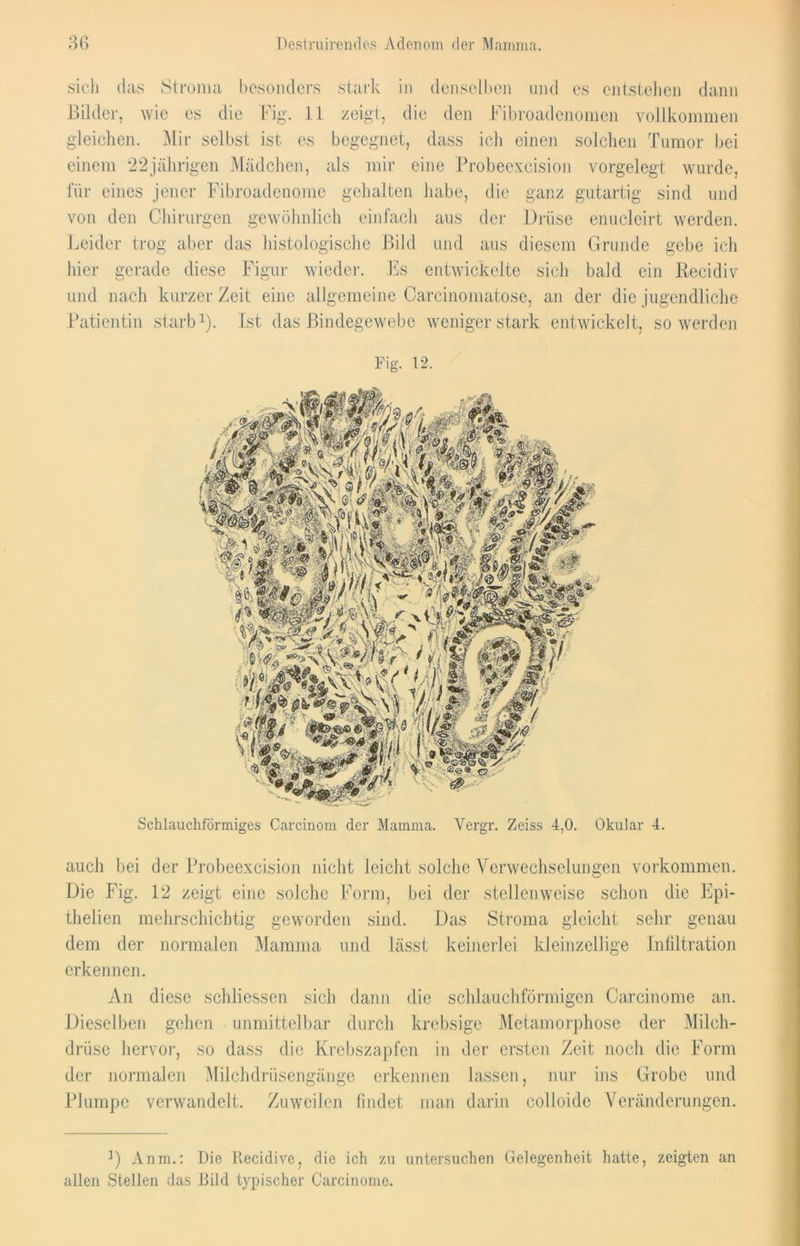 sich das Stroma besonders stark in denselben und es entstehen dann Bilder, wie cs die Fig. 11 zeigt, die den Fibroadenomen vollkommen gleichen. Mir selbst ist es begegnet, dass ich einen solchen Tumor bei einem 22jährigen Mädchen, als mir eine Probeexcision vorgelegt wurde, für eines jener Fibroadenome gehalten habe, die ganz gutartig sind und von den Chirurgen gewöhnlich einfach aus der Drüse enucleirt werden. Leider trog aber das histologische Bild und aus diesem Grunde gebe ich hier gerade diese Figur wieder. Es entwickelte sich bald ein Recidiv und nach kurzer Zeit eine allgemeine Carcinomatose, an der die jugendliche Patientin starb1). Ist das Bindegewebe wenigerstark entwickelt, so werden Schlauchförmiges Carcinom der Mamma. Vergr. Zeiss 4,0. Okular 4. auch bei der Probeexcision nicht leicht solche Verwechselungen Vorkommen. Die Fig. 12 zeigt eine solche Form, bei der stellenweise schon die Epi- thelien mehrschichtig geworden sind. Das Stroma gleicht sehr genau dem der normalen Mamma und lässt keinerlei kleinzellige Infiltration erkennen. An diese schliessen sich dann die schlauchförmigen Carcinome an. Dieselben gehen unmittelbar durch krebsige Metamorphose der Milch- drüse hervor, so dass die Krebszapfen in der ersten Zeit noch die Form der normalen Milchdrüsengänge erkennen lassen, nur ins Grobe und Plumpe verwandelt. Zuweilen findet man darin colloide Veränderungen. ]) Anm.: Die Recidive, die ich zu untersuchen Gelegenheit hatte, zeigten an allen Stellen das Bild typischer Carcinome.