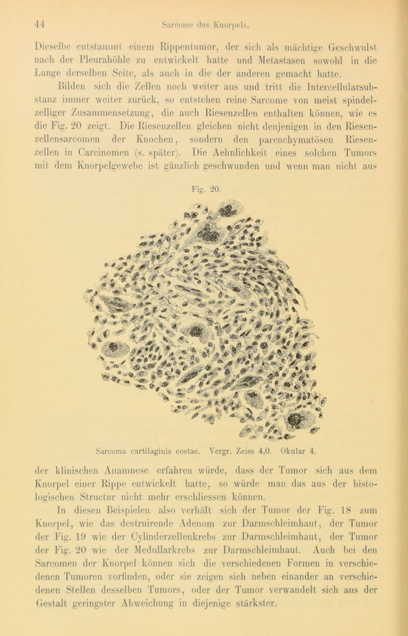 Dieselbe entstammt einem Rippentumor, der sicli als mächtige Geschwulst nach der Pleurahöhle zu entwickelt hatte und Metastasen sowohl in die Lunge derselben Seite, als auch in die der anderen gemacht hatte. Bilden sich die Zellen noch weiter aus und tritt die lntercellularsub- stanz immer weiter zurück, so entstehen reine Sarcome von meist spindel- zelliger Zusammensetzung, die auch Riesenzellen enthalten können, wie cs die Fig. 20 zeigt. Die Riesenzellen gleichen nicht denjenigen in den Riesen- zellensarcomen der Knochen, sondern den parenchymatösen Riesen- zeilen in Carcinomen (s. später). Die Aehnlichkeit eines solchen Tumors mit dem Knorpelgewebc ist gänzlich geschwunden und wenn man nicht aus Fig. 20. Sarcoma cartilaginis costae. Vergr. Zeiss 4,0. Okular 4. der klinischen Anamnese erfahren würde, dass der Tumor sich aus dem Knorpel einer Rippe entwickelt hatte, so würde man das aus der histo- logischen Structur nicht mehr erschliesscn können. In diesen Beispielen also verhält sich der Tumor der Fig. 18 zum Knorpel, wie das destruirende Adenom zur Darmschleimhaut, der Tumor der Fig. 19 wie der Cylinderzellenkrebs zur Darmschleimhaut, der Tumor der Fig. 20 wie der Medullarkrebs zur Darmschleimhaut. Auch bei den Sarcomen der Knorpel können sich die verschiedenen Formen in verschie- denen Tumoren vorlinden, oder sie zeigen sich neben einander an verschie- denen Stellen desselben Tumors, oder der Tumor verwandelt sich aus der Gestalt geringster Abweichung in diejenige stärkster.