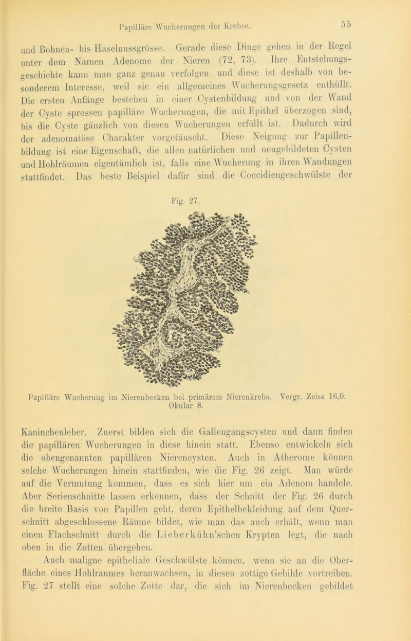Papilläre Wucherungen der Krebse. und Bohnen- bis Haselnussgrösse. Gerade diese Dinge gehen in der Regel unter dem Namen Adenome der Nieren (72, 73). Ihre Entstehungs- geschichte kann man ganz genau verfolgen und diese ist deshalb von be- sonderem Interesse, weil sic ein allgemeines Wucherungsgesetz enthüllt. Die ersten Anfänge bestehen in einer Cystenbildung und von der Wand der Cyste sprossen papilläre Wucherungen, die mit Epithel überzogen sind, bis die Cyste gänzlich von diesen Wucherungen erfüllt ist. Dadurch wird der adenomatöse Charakter vorgetäuscht. Diese Neigung zur Papillen- bildung ist eine Eigenschaft, die allen natürlichen und neugebildeten Cysten und Hohlräumen eigentümlich ist, falls eine Wucherung in ihren Wandungen stattfindet. Das beste Beispiel dafür sind die Coccidiengeschwülste der Fig. 27. Papilläre Wucherung im Nierenbecken bei primärem Nierenkrebs. Vergr. Zeiss 16,0. Okular 8. Kaninchenleber. Zuerst bilden sich die Gallengangscysten und dann finden die papillären Wucherungen in diese hinein statt. Ebenso entwickeln sich die obengenannten papillären Nierencysten. Auch in Atherome können solche Wucherungen hinein stattfinden, wie die Fig. 26 zeigt. Man würde auf die Vermutung kommen, dass es sich hier um ein Adenom handele. Aber Serienschnitte lassen erkennen, dass der Schnitt der Fig. 26 durch die breite Basis von Papillen geht, deren Epithelbekleidung auf dem Quer- schnitt abgeschlossene Räume bildet, wie man das auch erhält, wenn man einen Flachschnitt durch die Lieberkühn’schen Krypten legt, die nach oben in die Zotten übergehen. Auch maligne epitheliale Geschwülste können, wenn sic an die Ober- fläche eines Hohlraumes heranwachsen, in diesen zottige Gebilde vortreiben. Fig. 27 stellt eine solche Zotte dar, die sich im Nierenbecken gebildet