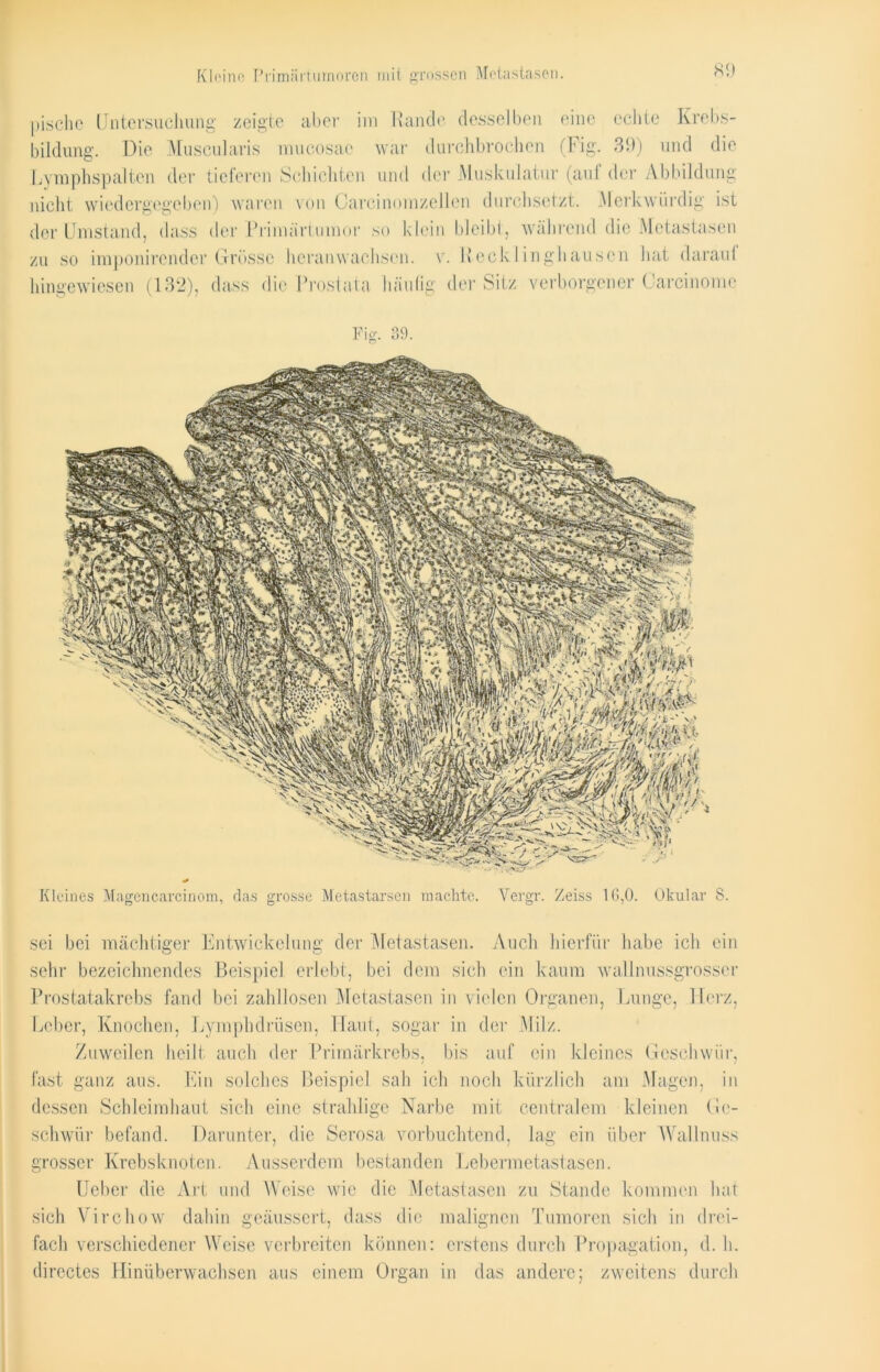 Kleine; Prirmirtumoren mit grossen Metastasen. pische Untersuchung zeigte aber im Rande desselben eine echte Krebs- bildung. Die Muscularis mucosae war durchbrochen (Fig. 39) und die Lymphspalten der tieferen Schichten und der Muskulatur (auf der Abbildung nicht wiedergegeben) waren von Carcinomzellen durchsetzt. Merkwürdig ist der Umstand, dass der Primärtumor so klein bleibt, während die Metastasen zu so imponirender Grösse heran wachsen, v. Recklinghausen hat darauf hingewiesen (132), dass die Prostata häufig der Sitz verborgener Carcinome sei bei mächtiger Entwickelung der Metastasen. Auch hierfür habe ich ein sehr bezeichnendes Beispiel erlebt, bei dem sich ein kaum wallnussgrosser Prostatakrebs fand bei zahllosen Metastasen in vielen Organen, Lunge, Herz, Leber, Knochen, Lymphdrüsen, Haut, sogar in der Milz. Zuweilen heilt auch der Primärkrebs, bis auf ein kleines Geschwür, fast ganz aus. Ein solches Beispiel sah ich noch kürzlich am Magen, in dessen Schleimhaut sich eine strahlige Narbe mit centralem kleinen Ge- schwür befand. Darunter, die Serosa vorbuchtend, lag ein über Wallnuss grosser Krebsknoten. Ausserdem bestanden Lebermetastasen. Ueber die Art und Weise wie die Metastasen zu Stande kommen hat malignen Tumoren sich in drei- sich Virchow dahin geäussert, dass die fach verschiedener Weise verbreiten können: erstens durch Propagation, d. h. dircctes Hinüberwachsen aus einem Organ in das andere; zweitens durch