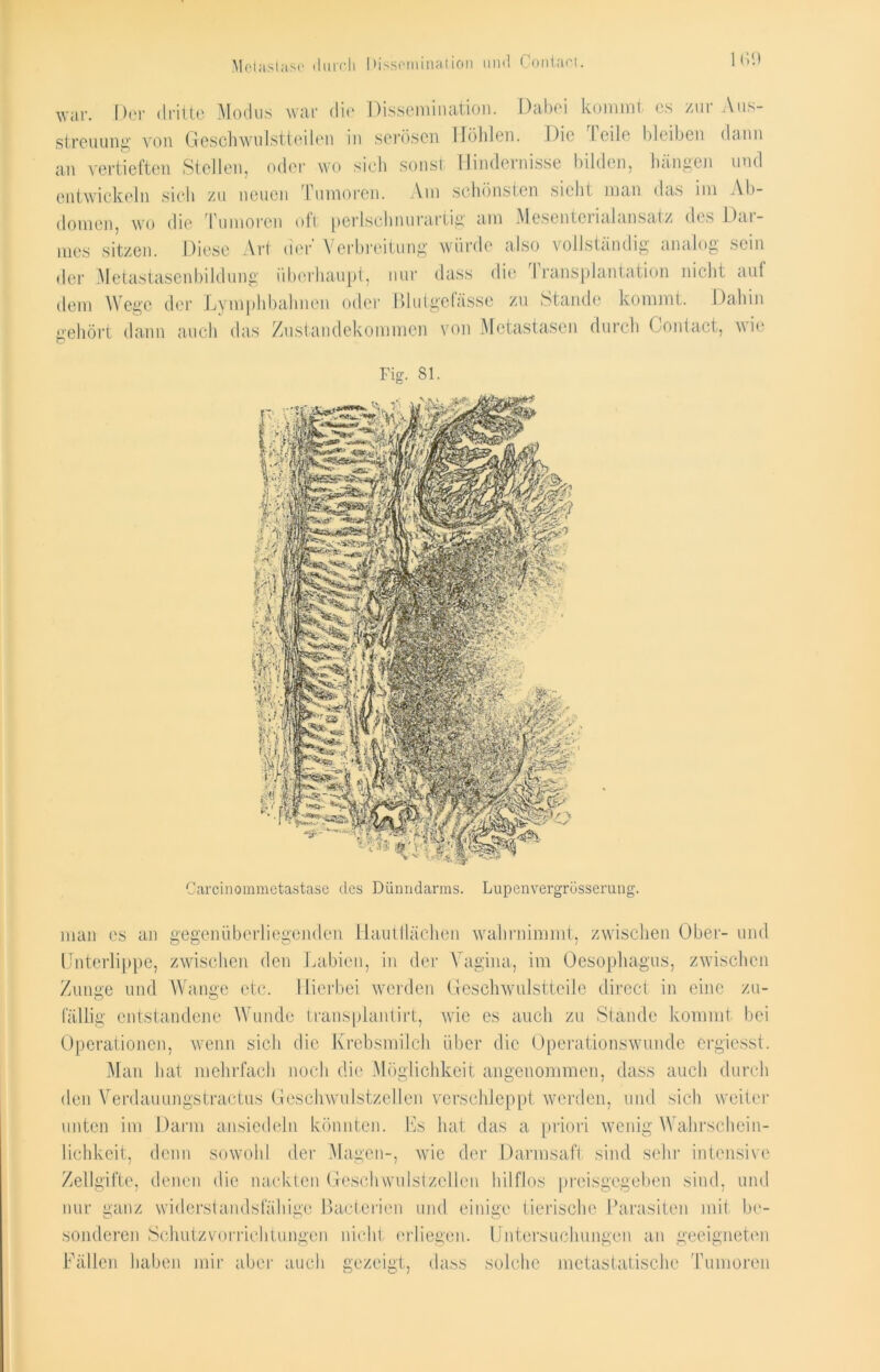 Metastase durch Disso-niination und Oontaci. 1 (V.) Weil*. [)or dritte Modus war die Dissemination. Dabei kommt es zui Aus- streuung von Geschwulstteilen in serösen Höhlen. Die Teile bleiben dann an vertieften Stellen, oder wo sich sonst Hindernisse bilden, hängen und entwickeln sielt zu neuen Tumoren. Am schönsten sicht man das im Ab- domen, wo die Tumoren oft perlschnurartig am Mescntcrialansatz des Dat- ums sitzen. Diese Art der' Verbreitung würde also vollständig analog sein der Metastasenbildung überhaupt, nur dass die I ransplantation nicht auf dem Wege der Lymphbalmen oder Blutgefässe zu Stande kommt. Dahin gehört dann auch das Zustandekommen von Metastasen durch Contact, wie Fig. 81. Carcinommetastase cles Dünndarms. Lupenvergrüsserung. man es an gegenüberliegenden Hautllächen wahrnimmt, zwischen Ober- und Unterlippe, zwischen den Labien, in der Vagina, im Oesophagus, zwischen Zunge und Wange etc. Hierbei werden Geschwulstteile direct in eine zu- fällig entstandene Wunde Iransplantirt, wie es auch zu Stande kommt bei Operationen, wenn sich die Krebsmilch über die Operationswunde ergiesst. Man hat mehrfach noch die Möglichkeit angenommen, dass auch durch den Verdauungstractus Geschwulstzellen verschleppt werden, und sich weiter unten im Darm ansiedeln könnten. Es hat das a priori wenig Wahrschein- lichkeit, denn sowohl der Magen-, wie der Darmsaft sind sehr intensive Zellgifte, denen die nackten Geschwulstzellen hilflos preisgegeben sind, und nur ganz widerstandsfähige Bacterien und einige tierische Parasiten mit be- sonderen Schutzvorrichtungen nicht erliegen. Untersuchungen an geeigneten Fällen haben mir aber auch gezeigt, dass solche metastatische Tumoren