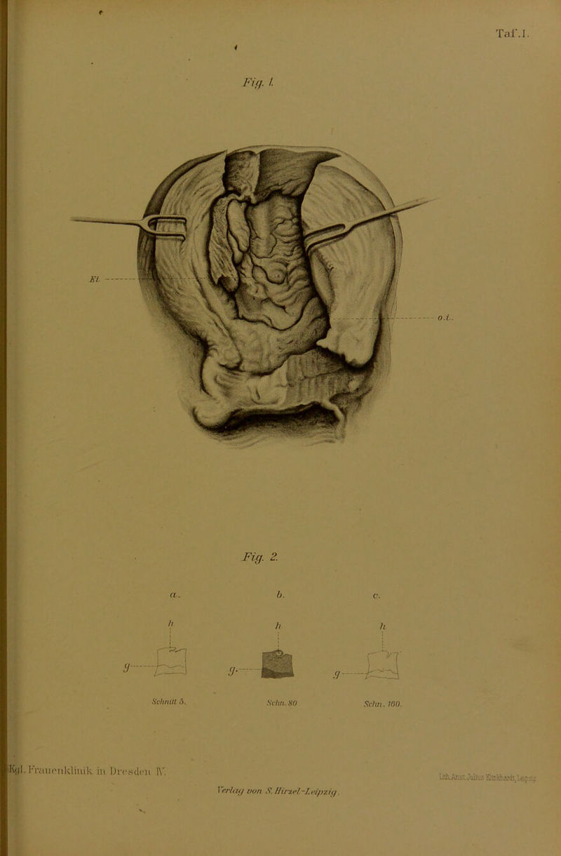 Fi fl- !■ Tat'.I. Fix,. 2. a. b. h c. 3 <J- , a Schmu ö. Schn. SO Schn. WO. ■Kgl.Frauenklinik in Dresden IV. LitfrAnsi. Julius KinMiardt, leip:w