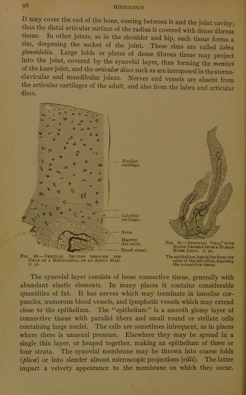 g8 HISTOLOGY It may cover the end of the bone, coming between it and the joint cavity; thus the distal articular surface of the radius is covered with dense fibrous tissue. In other joints, as in the shoulder and hip, such tissue forms a nm, deepening the socket of the joint. These rims are called labra glenoidalia. Large folds or plates of dense fibrous tissue may project into the joint, covered by the synovial layer, thus forming the menisci of the knee joint, and the articular discs such as are interposed in the sterno- clavicular and mandibular joints. Nerves and vessels are absent from the articular cartilages of the adult, and also from the labra and articular discs. Hyaline cartilage. Calcified cartilage. Bone. Marrow (fat' cells). Blood vessel. Pig. 86.—Vertical Section through the Head of a Metacarpal of an Adult Man. X so. Fig. 87.—Synovial Villi^with Blood Vessels from a Human Knee Joint, x 50. The epithelium has fallen from the apex of the left villus, exposing the connective tissue. The synovial layer consists of loose connective tissue, generally with abundant elastic elements. In many places it contains considerable quantities of fat. It has nerves which may terminate in lamellar cor- puscles, numerous blood vessels, and lymphatic vessels which may extend close to the epithelium. The “epithelium” is a smooth glossy layer of connective tissue with parallel fibers and small round or stellate cells containing large nuclei. The cells are sometimes infrequent, as in places where there is unusual pressure. Elsewhere they may be spread in a single thin layer, or heaped together, making an epithelium of three or four strata. The synovial membrane may be thrown into coarse folds (pliccB) or into slender almost microscopic projections {villi). The latter impart a velvety appearance to the membrane on which they occur.