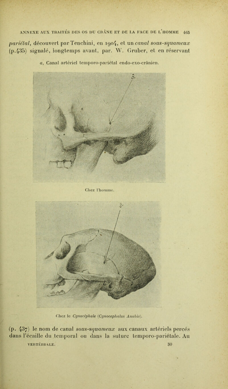 pariétal, découvert parTenchini, en 1904, et \m canal sous-squameux (p.435) signalé, longtemps avant, par. W. Gruber, et en réservant a, Canal artériel temporo-pariétal endo-exo-crânien. ca- chez l’homme. Chez le Cynocéphale (Cynocephnlas Anubis). (p. 437) le nom de canal sous-squameux aux canaux artériels percés dans l’écaille du temporal on dans la suture temporo-pariétale. Au VERTÉBRALE. 30