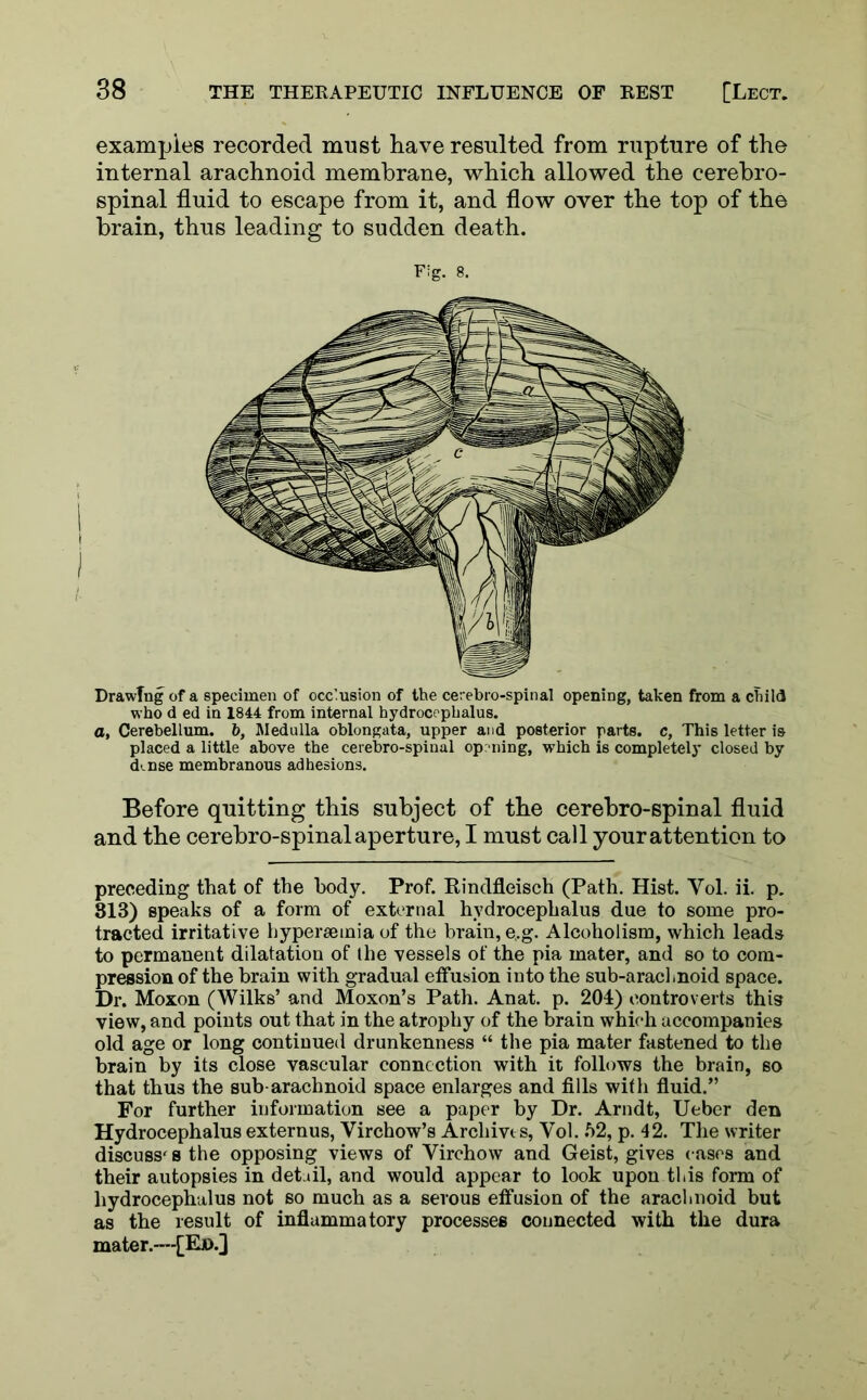 examples recorded must have resulted from rupture of the internal arachnoid membrane, which allowed the cerebro- spinal fluid to escape from it, and flow over the top of the brain, thus leading to sudden death. Fig. 8. Drawing of a specimen of occlusion of the cerebro-spinal opening, taken from a child who d ed in 1844 from internal hydrocephalus, a, Cerebellum, b, Medulla oblongata, upper and posterior parts, c. This letter is placed a little above the cerebro-spinal opening, which is completely closed by cknse membranous adhesions. Before quitting this subject of the cerebro-spinal fluid and the cerebro-spinal aperture, I must call your attention to preceding that of the body. Prof. Rindfleisch (Path. Hist. Vol. ii. p. 813) speaks of a form of external hydrocephalus due to some pro- tracted irritative hyperseinia of the brain, e,.g. Alcoholism, which leads to permanent dilatation of the vessels of the pia mater, and so to com- pression of the brain with gradual effusion into the sub-arachnoid space. Dr. Moxon (Wilks’ and Moxon’s Path. Anat. p. 204) controverts this view, and points out that in the atrophy of the brain which accompanies old age or long continued drunkenness “ the pia mater fastened to the brain by its close vascular connection with it follows the brain, so that thus the sub arachnoid space enlarges and fills with fluid.” For further information see a paper by Dr. Arndt, Ueber den Hydrocephalus externus, Virchow’s Archives, Vol. 52, p. 42. The writer discuss's the opposing views of Virchow and Geist, gives cases and their autopsies in detail, and would appear to look upon this form of hydrocephalus not so much as a serous effusion of the arachnoid but as the result of inflammatory processes connected with the dura mater.—[E».]