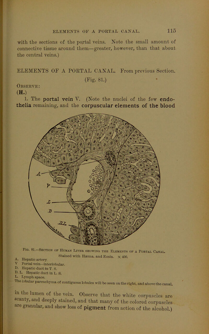 with the sections of the postal veins. Note the small amount of connective tissue around them—greater, however, than that about the central veins.) ELEMENTS OF A PORTAL CANAL. From previous Section. (Fig. 81.) Observe: (H.) 1. The portal vein V. (Note the nuclei of the few endo- thelia remaining, and the corpuscular elements of the blood Fig. 81. Section op Homan Liver showing the Elements op a Portal Canal. Stained with Hsema. and Eosin. x 400. A. Hepatic artery. V Portal vein—interlobular. D- Hepatic duct in T. S. D. L. Hepatic duct in L. S. L. Lymph space. The lobular parenchyma of contiguous lobules will be seen on the right, and above the canal. m the lumen of the vein. Observe that the white corpuscles are anty, and deeply stained, and that many of the colored corpuscles are granular, and show loss of pigment from action of the alcohol.)