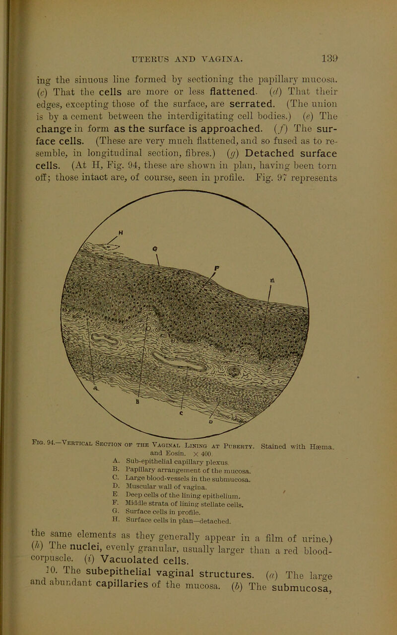 nig the sinuous line formed by sectioning the papillary mucosa. (c) That the cells are more or less flattened, (d) That their edges, excepting those of the surface, are serrated. (The union is by a cement between the interdigitating cell bodies.) (e) The change in form as the surface is approached. (/) The sur- face cells. (These are very much flattened, and so fused as to re- semble, in longitudinal section, fibres.) (y) Detached surface cells. (At H, Fig. 94, these are shown in plan, having been torn off; those intact are, of course, seen in profile. Fig. 97 represents Stained with Hsenn Fig. 94. Vertical Section op the Vaginal Lining at Puberty. and Eosin. x 400 Sub-epithelial capillary plexus Papillary arrangement of the mucosa. Large blood-vessels in the submucosa. Muscular wall of vagiua. Deep cells of the lining epithelium. Middle strata of lining stellate cells. Surface cells in profile. Surface cells in plan—detached. the same elements as they generally appear in a film of urine, () ihe nuclei> evenly granular, usually larger than a red blood corpuscle, (i) Vacuolated cells. 10. The subepithelial vaginal structures, (a) The barer and abundant capillaries of the mucosa. (b) The submucosa A. B. C. D. E F. G. H.
