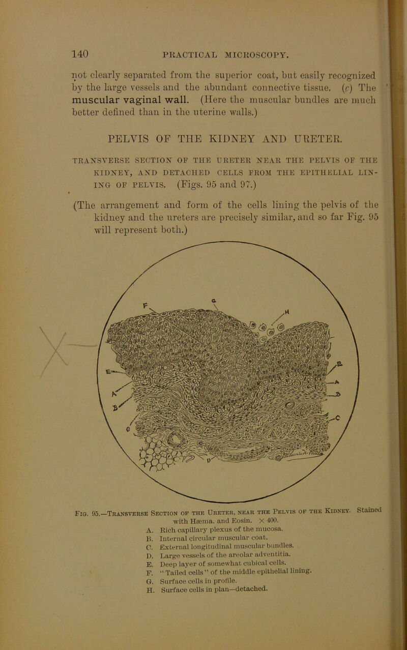 not clearly separated from the superior coat, but easily recognized by the large vessels and the abundant connective tissue, (c) The muscular vaginal wall. (Here the muscular bundles are much better defined than in the uterine walls.) PELVIS OF THE KIDNEY AND URETER. TRANSVERSE SECTION OF THE URETER NEAR THE PELVIS OF THE KIDNEY, AND DETACHED CELLS FROM THE EPITHELIAL LIN- ING OF PELVIS. (Figs. 95 and 97.) (The arrangement and form of the cells lining the pelvis of the kidney and the ureters are precisely similar, and so far Fig. 95 will represent both.) Fig. 95.—Transverse Section op the Ureter, near the Pelvis of the Kidney. Stained with Heema. and Eosin. X 400. A. Rich capillary plexus of the mucosa. B. Internal circular muscular coat. C. External longitudinal muscular bundles. D. Large vessels of the areolar adventitia. E. Deep layer of somewhat cubical cells. F. “ Tailed cells” of the middle epithelial lining. G. Surface cells in profile. II. Surface cells in plan—detached.
