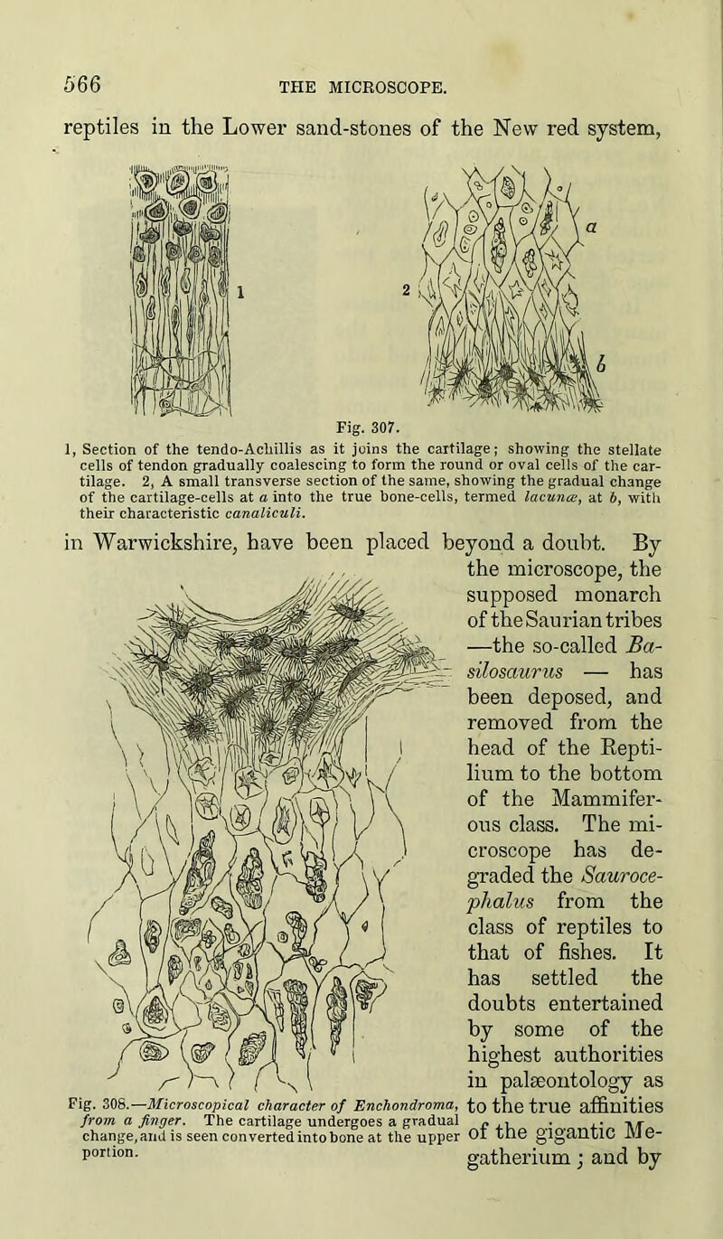 reptiles in the Lower sand-stones of the New red system, 1, Section of the tendo-Acliillis as it joins the cartilage; showing the stellate cells of tendon gradually coalescing to form the round or oval cells of the car- tilage. 2, A small transverse section of the same, showing the gradual change of the cartilage-cells at a into the true hone-cells, termed lacuna, at b, with their characteristic canaliculi. in Warwickshire, have been placed beyond a doubt. By the microscope, the supposed monarch of the Saurian tribes —the so-called Ba- silosaurus — has been deposed, and removed from the head of the Repti- lium to the bottom of the Mammifer- ous class. The mi- croscope has de- graded the Sauroce- phalus from the class of reptiles to that of fishes. It has settled the doubts entertained by some of the highest authorities in palaeontology as Fig. 308.—Microscopical character of Enchondroma, to the true affinities from, a finger. The cartilage undergoes a gradual « , . . ■ change, and is seen converted into bone at the upper 01 tilG gigantic 1YJ6- porlion- gatherium; and by