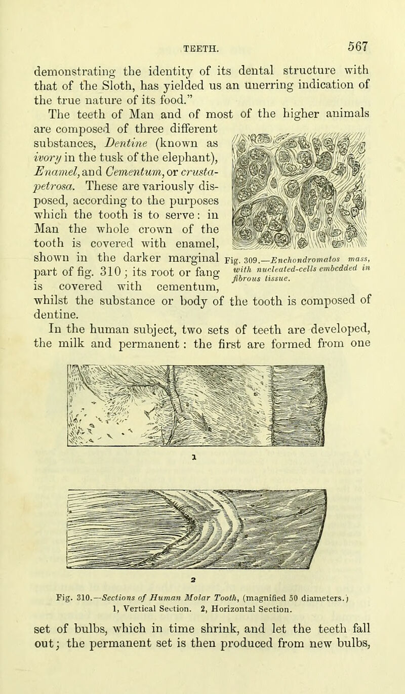 demonstrating the identity of its dental structure with that of the Sloth, has yielded us an unerring indication of the true nature of its food.” The teeth of Man and of most of the higher animals are composed of three different substances. Dentine (known as ivory in the tusk of the elephant), Enamel, and Cementum, or crusta- petrosa. These are variously dis- posed, according to the purposes which the tooth is to serve: in Man the whole crown of the tooth is covered with enamel, shown in the darker marginal Fig. 309.—Enchondromatos mass, part of fig. 310 ; its root 01’ fang ™jth nurleated-cells embedded m 4 0 ' ® fibrous tissue. is covered with cementum, whilst the substance or body of the tooth is composed of dentine. In the human subject, two sets of teeth are developed, the milk and permanent: the first are formed from one 2 Fig. 310.—Sections of Human Molar Tooth, (magnified 50 diameters.) 1, Vertical Section. 2, Horizontal Section. set of bulbs, which in time shrink, and let the teeth fall out; the permanent set is then produced from new bulbs,