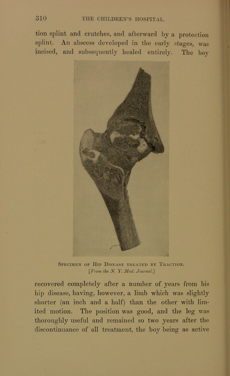 tion splint and crutches, and afterward by a protection splint. An abscess developed in the early stages, was incised, and subsequently healed entirely. The boy Specimen of Hip Disease treated by Traction. [From the N. Y. Med. Journal.] recovered completely after a number of years from his hip disease, having, however, a limb which was slightly shorter (an inch and a half) than the other with lim- ited motion. The position was good, and the leg was thoroughly useful and remained so two years after the discontinuance of all treatment, the boy being as active