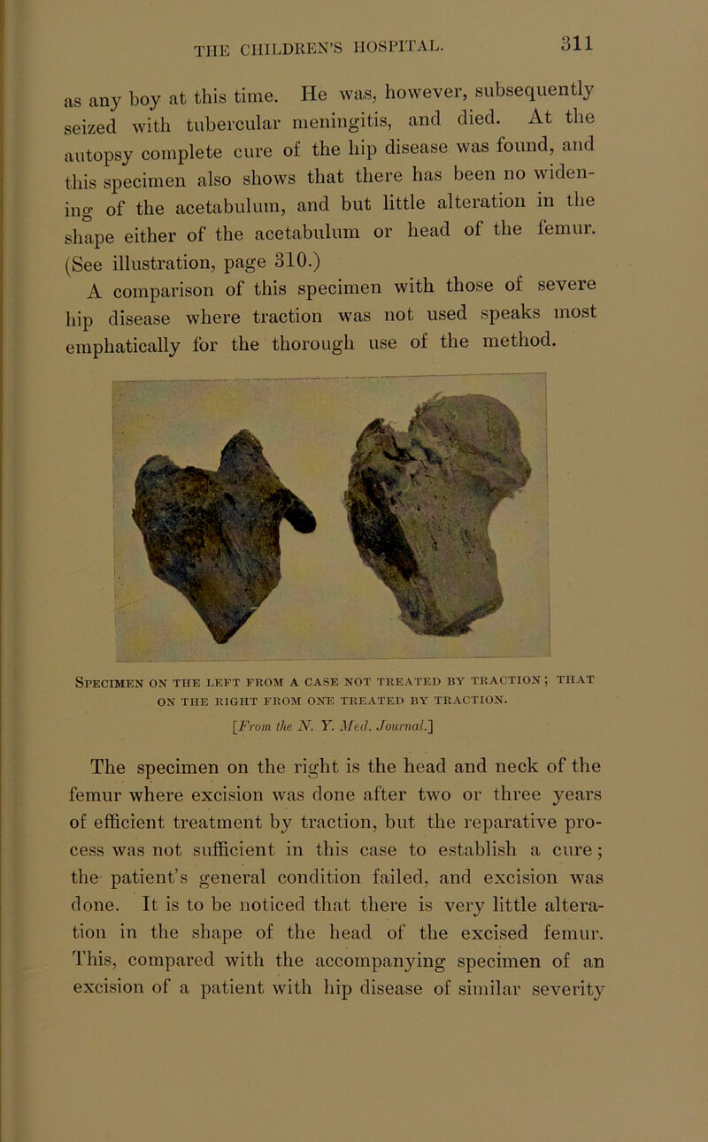 as any boy at this time. He was, however, subsequently seized with tubercular meningitis, and died. At the autopsy complete cure of the hip disease was found, and this specimen also shows that there has been no widen- ing of the acetabulum, and but little alteration in the shape either of the acetabulum or head of the femur. (See illustration, page 310.) A comparison of this specimen with those of seveie hip disease where traction was not used speaks most emphatically for the thorough use of the method. Specimen on the left from a case not treated by traction; that ON THE RIGHT FROM ONE TREATED BY TRACTION. [From the N. Y. Med. Journal.] The specimen on the right is the head and neck of the femur where excision was done after two or three years of efficient treatment by traction, but the reparative pro- cess was not sufficient in this case to establish a cure; the patient’s general condition failed, and excision was done. It is to be noticed that there is very little altera- tion in the shape of the head of the excised femur. This, compared with the accompanying specimen of an excision of a patient with hip disease of similar severity