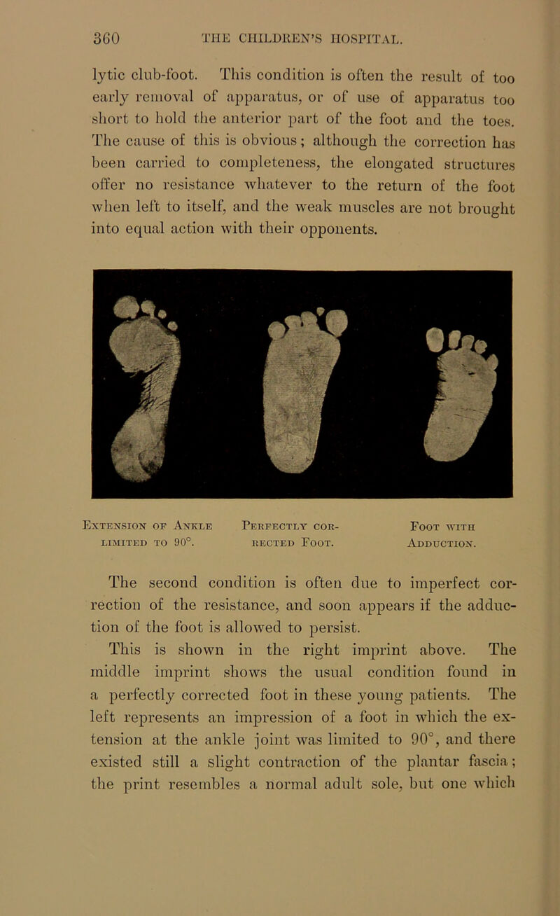 lytic club-foot. This condition is often the result of too early removal of apparatus, or of use of apparatus too short to hold the anterior part of the foot and the toes. The cause of this is obvious; although the correction has been carried to completeness, the elongated structures offer no resistance whatever to the return of the foot when left to itself, and the weak muscles are not brought into equal action with their opponents. The second condition is often due to imperfect cor- rection of the resistance, and soon appears if the adduc- tion of the foot is allowed to persist. This is shown in the right imprint above. The middle imprint shows the usual condition found in a perfectly corrected foot in these young patients. The left represents an impression of a foot in which the ex- tension at the ankle joint was limited to 90°, and there existed still a slight contraction of the plantar fascia; the print resembles a normal adult sole, but one which Extension of Ankle limited to 90°. Perfectly cor- rected Foot. Foot ■with Adduction.