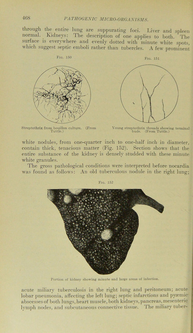 through the entire lung are suppurating foci. Liver and spleen normal. Kidneys: The description of one applies to both. The surface is everywhere and evenly dotted with minute white spots, which suggest septic emboli rather than tubercles. A few prominent Fig. 150 Fig. 151 Streptothrix from bouillon culture. (From Tuttle.) Young streptothrix threads showing terminal buds. (From Tuttle.) white nodules, from one-quarter inch to one-half inch in diameter, contain thick, tenacious matter (Fig. 152). Section shows that the entire substance of the kidney is densely studded with these minute white granules. The gross pathological conditions were interpreted before nocardia was found as follows: An old tuberculous nodule in the right lung; Fig. 152 Portion of kidney showing minute and large areas of infection. acute miliary tuberculosis in the right lung and peritoneum; acute lobar pneumonia, affecting the left lung; septic infarctions and pya?mic abscesses of both lungs, heart muscle, both kidneys, pancreas, mesenteric lymph nodes, and subcutaneous connective tissue. The miliary tuber-