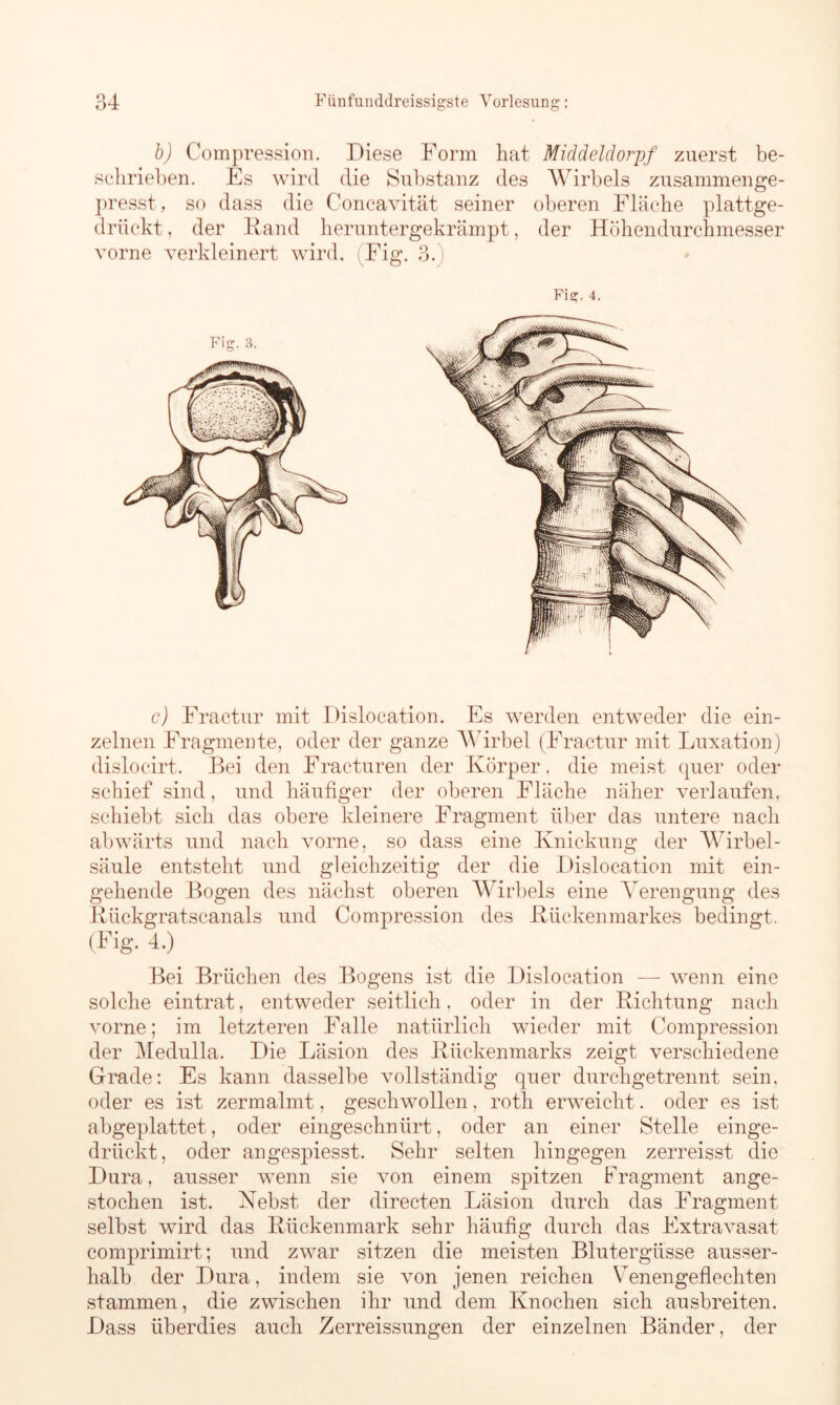 b) Compression. Diese Form hat Middeldorpf zuerst be- schrieben. Es wird die Substanz des Wirbels zusammenge- presst, so dass die Concavität seiner oberen Fläche plattge- drückt , der Rand heruntergekrämpt, der Höhendurchmesser vorne verkleinert wird. Fig. 3.) Fig. 4. c) Fractur mit Dislocation. Es werden entweder die ein- zelnen Fragmente, oder der ganze Wirbel (Fractur mit Luxation) dislocirt. Bei den Fracturen der Körper, die meist quer oder schief sind, und häufiger der oberen Fläche näher verlaufen, schiebt sich das obere kleinere Fragment über das untere nach abwärts und nach vorne, so dass eine Knickung der Wirbel- säule entsteht und gleichzeitig der die Dislocation mit ein- gehende Bogen des nächst oberen Wirbels eine Verengung des Rückgratscanals und Compression des Rückenmarkes bedingt. (Fig. 4.) Bei Brüchen des Bogens ist die Dislocation — wenn eine solche eintrat, entweder seitlich, oder in der Richtung nach vorne; im letzteren Falle natürlich wieder mit Compression der Medulla. Die Läsion des Rückenmarks zeigt verschiedene Grade: Es kann dasselbe vollständig quer durchgetrennt sein, oder es ist zermalmt, geschwollen, roth erweicht. oder es ist abgeplattet, oder eingeschnürt, oder an einer Stelle einge- drückt, oder angespiesst. Sehr selten hingegen zerreisst die Dura, ausser wenn sie von einem spitzen Fragment ange- stochen ist. Kebst der directen Läsion durch das Fragment selbst wird das Rückenmark sehr häufig durch das Extravasat comprimirt; und zwar sitzen die meisten Blutergüsse ausser- halb der Dura, indem sie von jenen reichen Venengeflechten stammen, die zwischen ihr und dem Knochen sich ausbreiten. Dass überdies auch Zerreissungen der einzelnen Bänder, der