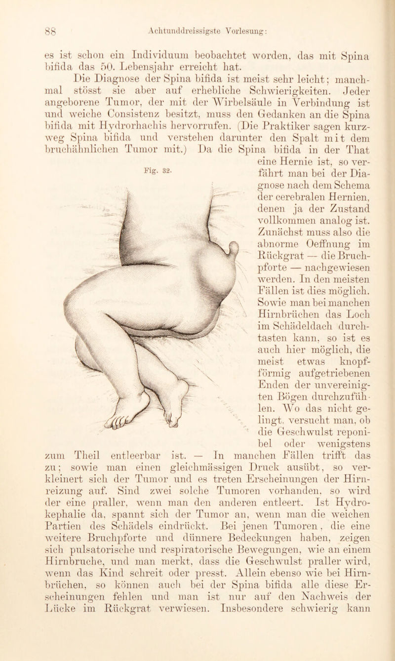 es ist schon ein Individuum beobachtet worden, das mit Spina bifida das 50. Lebensjahr erreicht hat. Die Diagnose der Spina bifida ist meist sehr leicht; manch- mal stösst sie aber auf erhebliche Schwierigkeiten. Jeder angeborene Tumor, der mit der Wirbelsäule in Verbindung ist und weiche Consistenz besitzt, muss den Gedanken an die Spina bifida mit Hydrorhachis hervorrufen. [Die Praktiker sagen kurz- weg Spina bifida und verstehen darunter den Spalt mit dem bruchähnlichen Tumor mit.) Da die Spina bifida in der That eine Hernie ist, so ver- *lg* 32‘ fährt man bei der Dia- gnose nach dem Schema der cerebralen Hernien, denen ja der Zustand vollkommen analog ist. Zunächst muss also die abnorme Oeffnnng im Klickgrat — die Bruch- pforte — nachgewiesen werden. In den meisten Fällen ist dies möglich. Sowie man bei manchen Hirnbrüchen das Loch im Schädeldach durch- tasten kann, so ist es auch hier möglich, die meist etwas knopf- förmig aufgetriebenen Enden der unvereinig- ten Bögen durchzufüh- len. Wo das nicht ge- lingt, versucht man, ob die Geschwulst reponi- bel oder wenigstens ist. — In manchen Fällen trifft das man einen gleichmässigen Druck ausübt, so ver- kleinert sich der Tumor und es treten Erscheinungen der Hirn- reizung auf. Sind zwei solche Tumoren vorhanden, so wird der eine praller, wenn man den anderen entleert. Ist Hydro- kephalie da, spannt sich der Tumor an, wenn man die weichen Partien des Schädels eindrückt. Bei jenen Tumoren, die eine weitere Bruchpforte und dünnere Bedeckungen haben, zeigen sich pulsatorische und respiratorische Bewegungen, wie an einem Hirnbruche, und man merkt, dass die Geschwulst praller wird, wenn das Kind schreit oder presst. Allein ebenso wie bei Hirn- brüchen, so können auch bei der Spina bifida alle diese Er- scheinungen fehlen und man ist nur auf den Nachweis der Lücke im Rückgrat verwiesen. zum Theil entleerbar zu; sowie Insbesondere schwierig kann