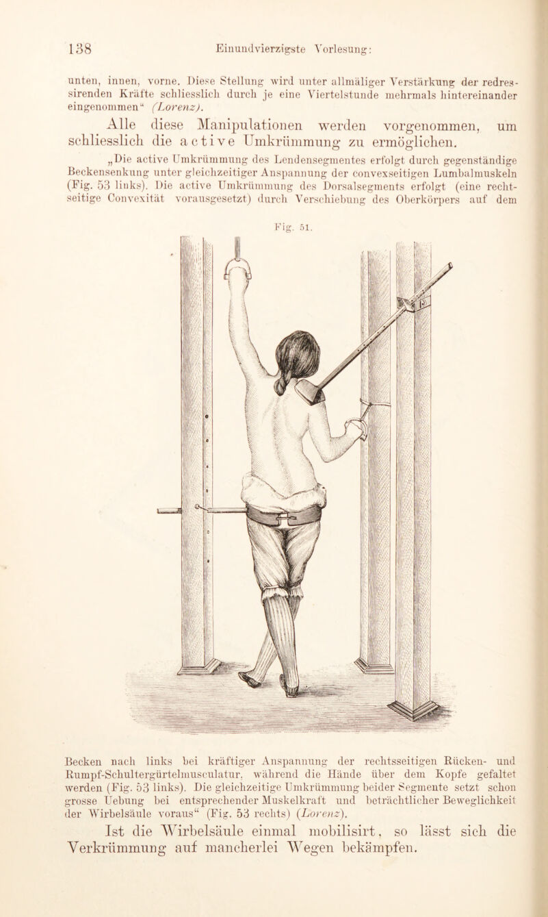 unten, innen, vorne. Diese Stellung wird unter allmäliger Verstärkung der redres- sirenden Kräfte schliesslich durch je eine Viertelstunde mehrmals hintereinander eingenommen•' (Lorenz). Alle diese Manipulationen werden vorgenommen, um schliesslich die active Ilmkrümmung zu ermöglichen. „Die active Umkrümmung des Lendensegmentes erfolgt durch gegenständige Beckensenkung unter gleichzeitiger Anspannung der convexseitigen Lumbalmuskeln (Fig. 53 links). Die active Umkrümmung des Dorsalsegments erfolgt (eine recht- seitige Convexität vorausgesetzt) durch Verschiebung des Oberkörpers auf dem Fig. 51. Becken nach links bei kräftiger Anspannung der rechtsseitigen Rücken- und Rumpf-Scliultergürtelmusculatur. während die Hände über dem Kopfe gefaltet werden (Fig. 53 links). Die gleichzeitige Umkrümmung beider Segmente setzt schon grosse Uebung bei entsprechender Muskelkraft und beträchtlicher Beweglichkeit der Wirbelsäule voraus“ (Fig. 53 rechts) {Lorenz). Ist die Wirbelsäule einmal mohilisirt, so lässt sieh die Verkrümmung auf mancherlei Wegen bekämpfen.