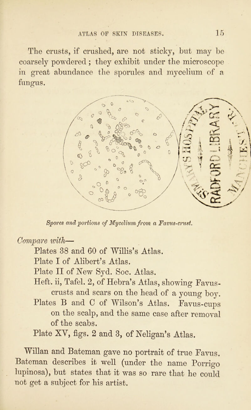 The crusts, if crushed, are not sticky, but may lie coarsely powdered ; they exhibit under the microscope in great abundance the sporules and mycelium of a fungus. Spores and portions of Mycelium from a Favus-crust. ComjMve tvith— Plates 38 and 60 of Willis’s Atlas. Plate I of Alibert’s Atlas. Plate II of New Syd. Soc. Atlas. Heft, ii, Tafel. 2, of Hebra’s Atlas, showing Favus- crusts and scars on the head of a young boy. Plates B and 0 of Wilson’s Atlas. Favus-cups on the scalp, and the same case after remoyal of the scabs. Plate XV, figs. 2 and 3, of Neligan’s Atlas. Willan and Bateman gave no portrait of true Favus. Bateman describes it well (under the name Porrigo lupinosa), but states that it was so rare that he could not get a subject for his artist.