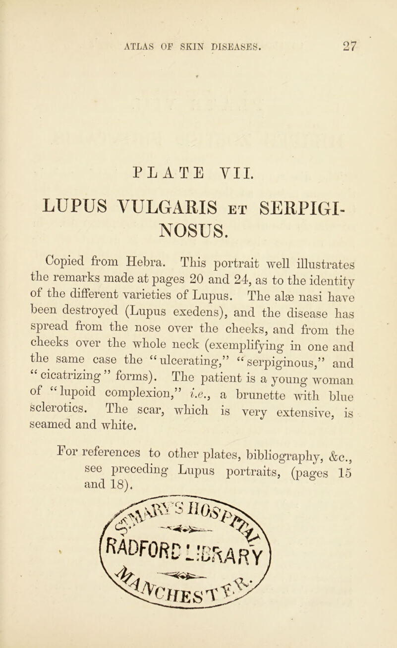 PLATE VII. LUPUS VULGARIS et SEIIPIGI- NOSUS. Copied from Hebra. This portrait Avell illustrates tlie remarks made at pages 20 and 24, as to the identity of the different varieties of Lupus. The alas nasi have been destroyed (Lupus exedens), and the disease has spread from the nose over the cheeks, and from the cheeks over the whole neck (exemplifying in one and the same case the ulcerating*,’^ “ serpiginous,” and “ cicatrizing ” forms). The patient is a young woman of “lupoid complexion,” i.e., a brunette ivith blue scleiotics. The scar, which is very extensive, is seamed and white. For references to other plates, bibliography, &c., see preceding Lupus iiortraits, (iiages 15 and 18).