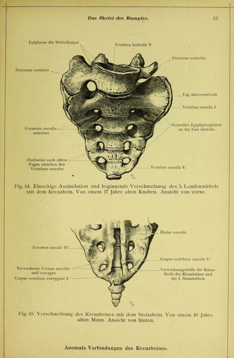 Epiphysen der Wirbelkörper Processus costarius ... P'oramina sacralia anteriora Theilweise noch offene Fugen zwischen den Vertebrae sacrales Vertebra lumbalis V. Processus costarius Lig. intervertebrale Vertebra sacralis I. vSecundäre Epiphysenplatten an der Pars lateralis Vertebra sacralis V. Fig'. 64. Einseitige Assimilation nnd beginnende Verschmelzung des 5. Lendenwirbels mit dem Kreuzbein. Von einem 17 Jahre alten Knaben. Ansicht von vorne. Hiatus sacralis Eoramen sacrale IV. Verwachsene Cornua sacralia und coccygea Corpus vertebrae coccygeae I. Corpus vertebrae sacralis V. Verwachsungsstelle der Seiten- theile des Kreuzbeines und des I. Steiss wirb eis big. 65. Verschmelzung des Kreuzbeines mit dem Steissbein. Von einem 40 Jahre alten Mann. Ansicht von hinten. Anomale Verbindungen des Kreuzbeines.