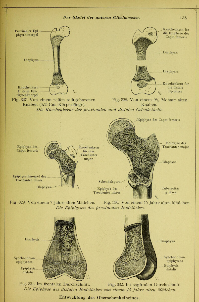 V. Knoclienkern für die Epiphyse des Caput femoris Diaphysis - Diapliysis Knochenkern für die distale Epiphyse Fig. 327. Von einem reifen todtgeborenen Fig. 328. Von einem 97*2 Monate alten Knaben (52'5 Cm. Körperlänge). Knaben. Die Knochenkerne der proximalen und distalen Gelenkstheile. Epiphyse des Caput femoris Epiphysenknorpel des Trochanter minor Knochenkern für den Trochanter major Diaphysis-- ,Epiphyse des Caput femoris . Epiphyse des Trochanter major Diaphyse Schenkelsporn^- Epiphyse des Trochanter minor Tuberositas glutaea Fig, 329. Von einem 7 Jahre alten Mädchen. Fig. 330. Von einem 15 Jahre alten Mädchen. Die Epiphysen des proximalen Endstückes. Diaphysis Synchondrosis epiphyseos Epiphysis distalis Diaphysis Synchondrosis epiphyseos Epiphysis distalis Fig. 331. Im frontalen Durchschnitt. Fig. 332. Im sagittalen Durchschnitt. Die Epiphyse des distalen Endstückes von einem 15 Jahre alten Mädchen.